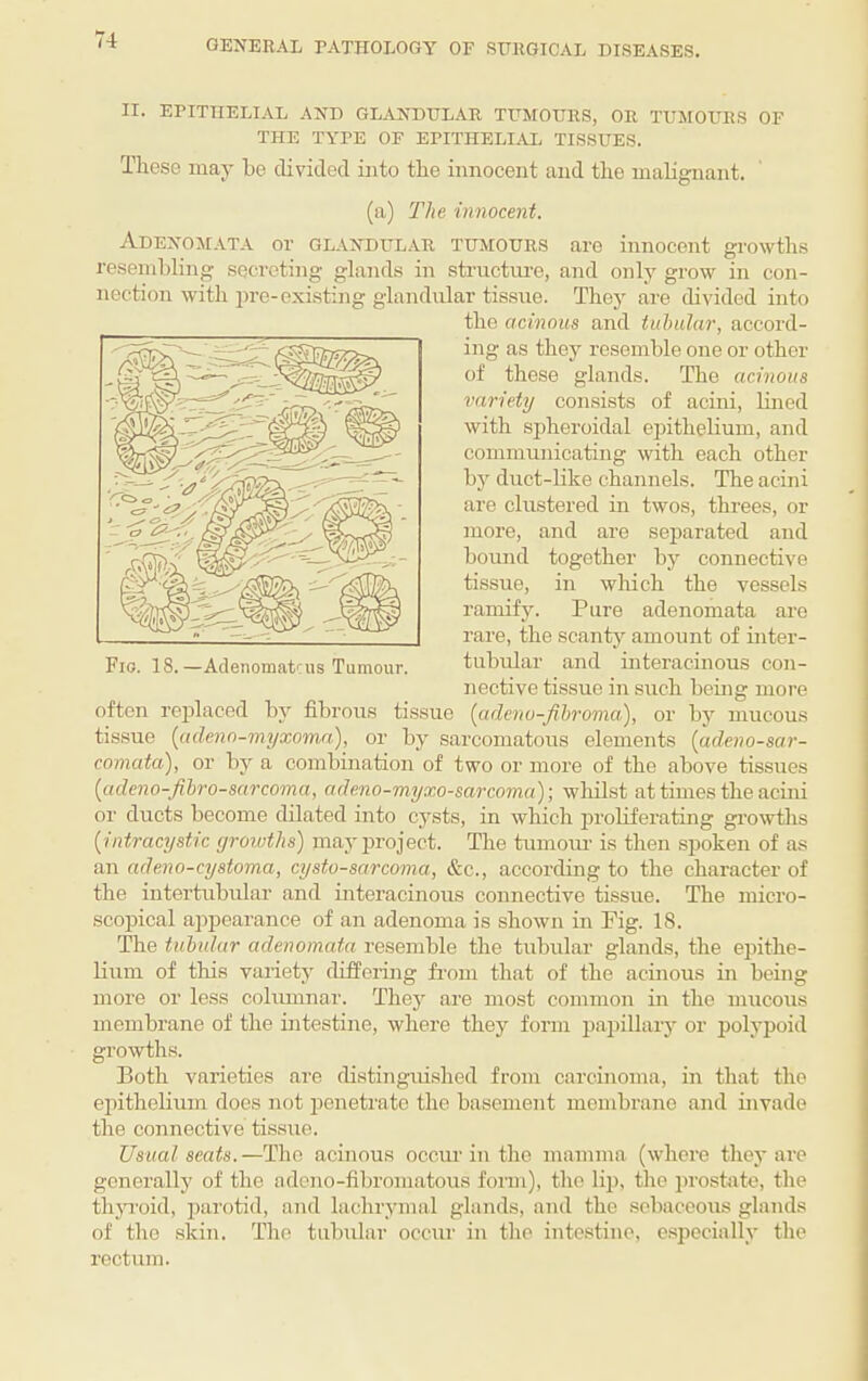 II. EPITHELIAL AND GLANDULAR TUMOURS, OR TUMOURS OF THE TYPE OF EPITHELDVL TISSUES. These may be divided into the innocent and the malignant. (a) The innocent. Adenomata or glandular tumours are innocent growths resembling secreting glands in sti’uctiu’e, and only grow in con¬ nection with pre-existing glandular tissue. They are cbvided into the acinous and tubular, accord¬ ing as they resemble one or other of these glands. The acinous variety consists of acini, lined with spheroidal epithelium, and communicating with each other bj^ duct-like channels. The acini are clustered in twos, thi’ees, or more, and are separated and bound together by connective tissue, in which the vessels ramify. Pure adenomata are rare, the scanty amount of inter¬ tubular and interacinous con¬ nective tissue in such being more often replaced by fibrous tissue [adeno-fihroma'), or by mucous tissue {adeno-myxoma), or by saz-comatous elements {udeno-sar- comata), or by a combination of two or more of the above tissues (ctdeno-Jibro-sarcoma, adeno-myxo-sarcoma)-, whilst at times the acini or ducts become dilated into cysts, in which proliferating gi’owths ['intracyst'ic growths) mayizi’oject. The tumoiu’ is then spoken of as an adeno-cystoma, cysto-sarcoma, &c., according to the character of the intertubular and intei’acinous connective tissue. The mici'o- scopical appeai’ance of an adenoma is shown in Fig. 18. The tubular adenomata I’esemble the tizbular glands, the epithe¬ lium of this vaiiety diffei-ing fi-om that of the acinous in being more or less colimznar. They are most common in the mucous membrane of the intestine, where they foi’in izapillar}' or polypoid growths. Both varieties are distinguished from carcinoma, in that the epithelium does not penetrate the basement membrane and invade the connective tissue. Usual seats.—The acinous occur in the mamma (whei’e they are generally of the adeno-fibromatous fonn), the lip, the ])rostato, the thjToid, parotid, and lachrymal glands, and the sebaceous glands of the skin. The tubulai- occur in the intestine, especially the rectum. Fio. 18.—AclenomaPus Tumour.