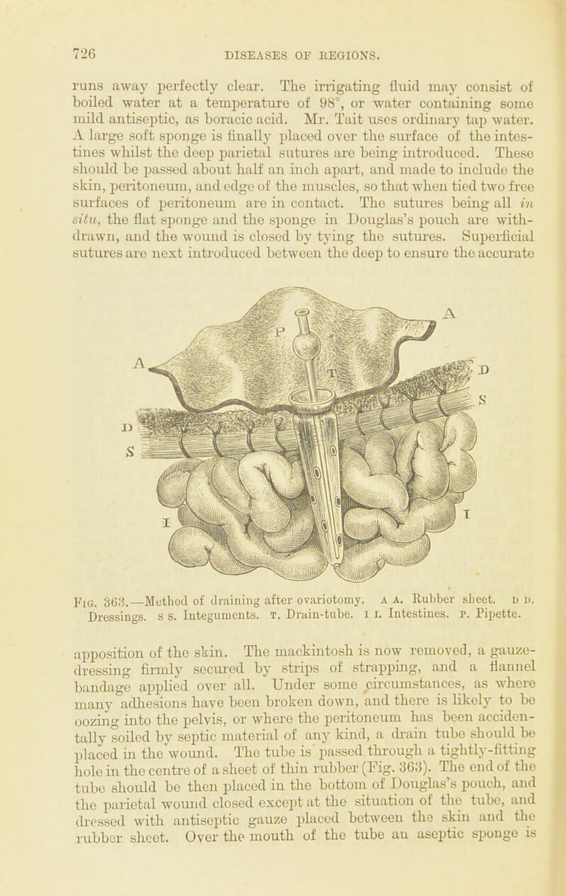 runs away perfectly clear. The irrigating fluid may consist of boded water at a temperature of 98°, or water containing some mild antiseptic, as boracic acid. Mr. Tait uses ordinary taj) water. A large soft sponge is finally placed over the surface of the intes¬ tines whilst the deep parietal sutm’es are being introduced. These should be passed about half an inch apart, and made to include the skin, peritoneiun, and edge of the muscles, so that when tied two free siu’faces of peritoneum are in contact. The sutures being all m situ, the flat sponge and the sponge in Douglas’s pouch are with¬ drawn, and the wound is closed by tjdng the sutm-es. Superficial sutures are next introduced between the deep to ensure the accurate Fig. 363.—Method of diaining after ovariotomy, a a. Eubber sheet, u d. Dressings, s s. Integuments, i. Drain-tube, i i. Intestines. P. Pipette. apposition of the skin. The mackintosh is now removed, a gauze¬ dressing firmly secui'ed by strips of strapping, and a flannel bandage applied over all. Under some circumstances, as whore many adhesions have been broken down, and there is likely to be oozing into the pelvis, or where the peritoneum has been acciden¬ tally soiled by septic material of any kind, a drain tube should be placed in the wound. The tube is passed through a tightly-fitting hole in the centre of a sheet of thin rubber (Dig. 363). The end of the tube should bo then placed in the bottom of Douglas’s pouch, and the parietal wound closed except at the situation of the tube, and drcssed with antiseptic gauze placed between the skin and the rubber sheet. Over the mouth of the tube an aseptic sponge is