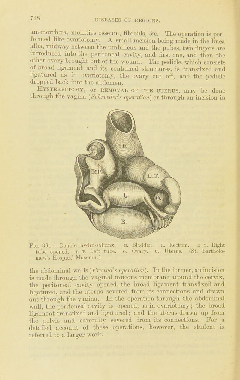 DISEASES OF llEGIONS. umenovrlidoa, mollities osseum, fibroids, &c. The operation is per¬ formed like ovariotomy. A small incision being made ui tbe linea alba, midway between the nmbilicus and the pubes, two fingers are introduced into the iieritoneal cavitj'', and fii'st one, and then the other ovary brought out of the wound. The pedicle, which consists of broad ligament and its contained structures, is transfixed and ligatm-ed as in ovariotomy, the ovary cut off, and the pedicle dropped back into the abdomen. Hysterectomy, or removal of the uterus, may be done through the vagina {Schroeder's operation) or through an incision in Fig. 364. —Double hyclro-salpinx. b. Bladder. r. Rect.um. k t. Right tube opened, l t. Left tube. o. Ovary, u. Uterus. (St. Bartholo¬ mew's Hospital Museum.) the abdominal walls [Freund's operation). In the former, an incision is made through the vaginal mucous membrane around the cervix, the peritoneal cavity opened, the broad ligament transfixed and ligatured, and the uterus severed from its connections and dravm out through the vagina. In the operation through the abdominal wall, the peritoneal cavity is opened, as in ovariotomy; the broad ligament transfixed and ligatimed; and the uterus drawn up from the pelvis and carefully severed fi-om its connections. For a detailed account of these operations, however, the student is referred to a larger work.