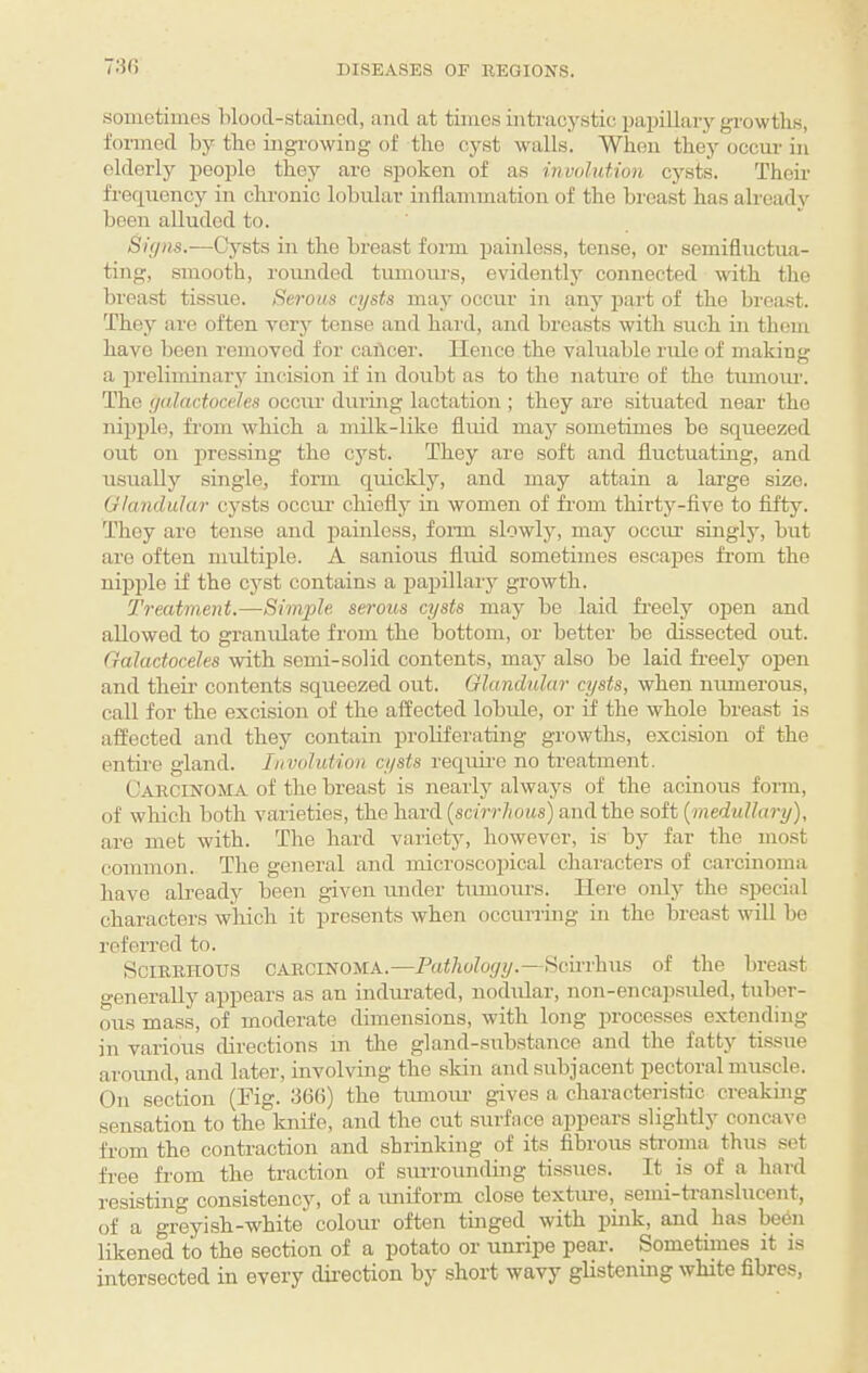 sometimes hlood-staiued, and at times intracystic papillary growths, formed by the mgi-owing of the cyst walls. Whou they occur in elderly people they are spoken of as involuUon cysts. Their frequency in chronic lobular inflammation of the breast has alroad} been alluded to. Cysts in the breast form painless, tense, or semifluctua- ting, smooth, roimded tumoiu's, evidently connected with the breast tissue. Serous cysts may occur in any part of the breast. They are often very tense and hard, and breasts with such in them have been removed for caiicer. Hence the valuable rule of makinsr a preliminary mcision if in doubt as to the nature of the tumom-. The yalactoceles occur during lactation ; they are situated near the nil)ple, from which a milk-like fluid may sometimes be squeezed out on pressing the cyst. They are soft and fluctuating, and usually single, form quickly, and may attain a large size. Glandular cysts occur chiefly m women of fi'om thirty-five to fifty. They are tense and painless, fonn slowljq may occiu singly, but are often multiple. A sanious fluid sometimes escapes fi-om the nipple if the cyst contains a papillary growth. Treatment.—Simple serous cysts may bo laid freely open and allowed to granulate from the bottom, or better be dissected out. Galactoceles with semi-solid contents, may also be laid freely open and their contents squeezed out. Glandular cysts, when niunerous, call for the excision of the affected lobule, or if the whole breast is affected and they contain proliferating growths, excision of the entire gland. Involution cysts requii’e no treatment. Cakcinoma of the breast is nearly always of the acinous form, of which both varieties, the hard [scirrhous) and the soft [medullary), are met with. The hard variety, however, is by far the most common. The general and microscopical characters of carcinoma have ah-eady been given under tumours. Here only the special characters which it presents when occurring in the breast will be referred to. SciEBHODS CARCINOMA.—Pathology.—Heurhus of the breast generally appears as an indm-ated, nodular, non-encapsuled, tuber¬ ous mass, of moderate dimensions, with long luocesses extending in various cbrections m the gland-substance and the fatty ti.ssue aroimd, and later, involving the skin and subjacent pectoral muscle. On section (Fig. 366) the timioiu gives a characteristic creakmg sensation to the knife, and the cut surface appears slightly concave from the contraction and shrinking of its fibrous stroma thus set free from the traction of surrounding tissues. It is of a hard resisting consistency, of a luiiform close textiue, semi-tianslucent, of a greyish-white colour often tuiged with pmk, and has bedn likened to the section of a potato or unripe pear. Sometimes it is intersected in every direction by short wavy glistening white fibres.