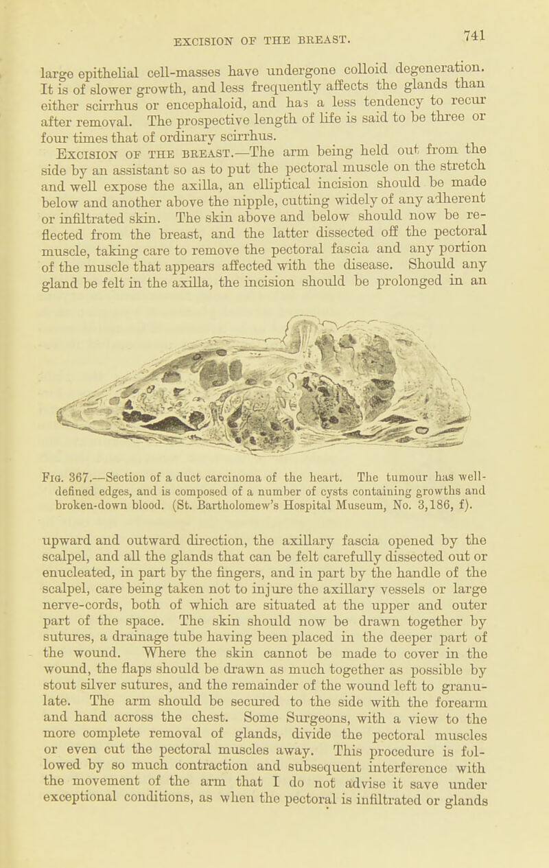 EXCISION OF THE BREAST. large epithelial cell-masses have undergone colloid degeneration. It is of slower growth, and less frequently affects the glands than either scirrhus or encephaloid, and has a less tendency to lecur after removal. The prospective length of life is said to be thi'ee or four times that of ordinary scirrhus. Excision of the breast.—The arm being held out from the side by an assistant so as to put the pectoral muscle on the stretch and well expose the axilla, an elliptical incision should be made below and another above the nipple, cutting widely of any adherent or infiltrated skin. The skin above and below should now be re¬ flected from the breast, and the latter dissected off the pectoral mnscle, taking care to remove the pectoral fascia and any portion of the muscle that appears affected with the disease. Should any gland be felt in the axilla, the incision shordd be prolonged in an Fig. 367.—Section of a duct carcinoma of the heart. The tumour has well- defined edges, and is composed of a number of cysts containing growths and broken-down blood. (St. Bartholomew’s Hospital Museum, No. 3,186, f). upward and outward direction, the axillary fascia opened by the scalpel, and aU the glands that can be felt carefully dissected out or enucleated, in part by the fingers, and in part by the handle of the scalpel, care being taken not to injure the axillary vessels or large nerve-cords, both of which are situated at the upper and outer part of the space. The skin should now be drawn together by sutures, a drainage tube having been placed in the deeper part of the wormd. Where the skin cannot be made to cover in the wound, the flaps should be drawn as much together as possible by stout silver sutmes, and the remainder of the wound left to granu¬ late. The arm should be secm-ed to the side with the forearm and hand across the chest. Some Sm-geons, with a view to the more complete removal of glands, divide the pectoral muscles or even cut the pectoral muscles away. This procedure is fol¬ lowed by so much contraction and subsequent interference with the movement of the arm that I do not advise it save under exceptional conditions, as when the pectoral is infiltrated or glands