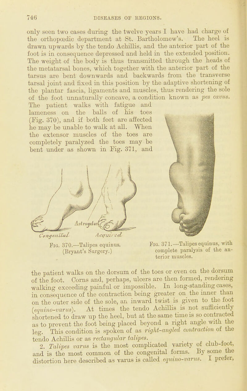 only seen two cases during the twelve years I have had charge ot the orthopoedic department at St. Bartholomew’s. The heel is drawn upwards hy the tendo Achillis, and the anterior part of the foot is in consequence depressed and held in the extended position. The weight of the body is thus transmitted thi'ough the heads of the metatarsal hones, which together with the anterior part of the tarsus are bent downwards and backwards from the transverse tarsal joint and fixed in this position by the adaptive shortening of the plantar fascia, ligaments and muscles, thus rendering the sole of the foot unnatmully concave, a condition known as pes cavus. The patient walks with fatigue and lameness on the balls of his toes (Fig. 370), and if both feet are affected he may be unable to walk at all. When the extensor muscles of the toes are completely paralyzed the toes may be bent under as shown in Fig. 371, and Fig. 370.—Talipes equinus. (Bryant’s Surgery.) Fig. 371.—Talipes equinus, with complete paralysis of the an¬ terior muscles. the patient walks on the dorsum of the toes or even on the dorsum of the foot. Corns and, perhaps, ulcers are then formed, rendering walking exceeding painful or impossible. In long-standing cases, in consequence of the contraction being greater on the inner than on the outer side of the sole, an inward twist is given to the foot {equino-varus). At times the tendo Achillis is not sufficiently shortened to draw up the heel, but at the same time is so contracted as to prevent the foot being placed beyond a right angle with the leg. This condition is spoken of as right-angled cuntradion of the tendo Achfitis or as rectangular talipes. 2. Talipes varus is the most complicated vaiiety of club-loot, and is the most common of the congenital forms. By some the distortion here desciibed as varus is called ajuino-varus. I prefer.