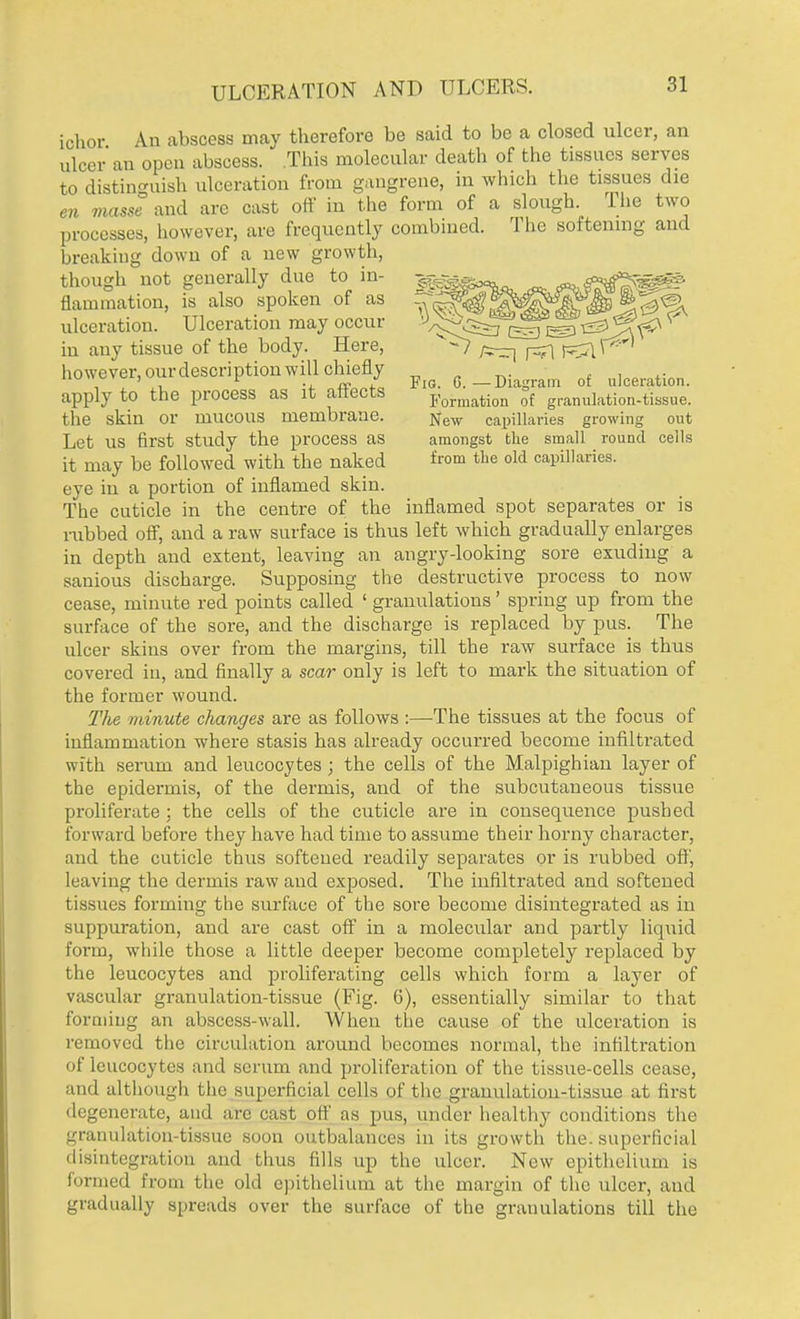 ULCERATION AND ULCERS. ichor An abscess may therefore be said to be a closed ulcer, an ulcer an open abscess. This molecular death of the tissues serves to distinguish ulceration from gangrene, in which the tissues die en masse and arc cast off in the form of a slough. The two processes, however, are frequently combined. The softening and breaking down of a new growth, though not generally due to in- flammation, is also spoken of as ulceration. Ulceration may occur y/v^^i^^^'^ in any tissue of the body. Here, v^ ^ ^ pr^p however, our description will chiefly , , „ .. * ' . r , re y Fig. G. — Diagram of ulceration, apply to the process as it aftects Formation of granulation-tissue, the skin or mucous membrane. capillaries growing out Let us first study the process as amongst the small round cells it may be followed with the naked from the old capillaries, eye in a portion of inflamed skin. The cuticle in the centre of the inflamed spot separates or is rubbed off, and a raw surface is thus left which gradually enlarges in depth and extent, leaving an angry-looking sore exuding a sanious discharge. Supposing the destructive process to now cease, minute red points called ' granulations' spring up from the surface of the sore, and the discharge is replaced by pus. The ulcer skins over from the margins, till the raw surface is thus covered in, and finally a scar only is left to mark the situation of the former wound. The minute changes are as follows :—The tissues at the focus of inflammation where stasis has already occurred become infiltrated with serum and leucocytes ; the cells of the Malpighian layer of the epidermis, of the dermis, and of the subcutaneous tissue proliferate : the cells of the cuticle are in consequence pushed forward before they have had time to assume their horny character, and the cuticle thus softened readily separates or is rubbed off, leaving the dermis raw and exposed. The infiltrated and softened tissues forming the surface of the sore become disintegrated as in suppuration, and are cast off in a molecular and partly liquid form, while those a little deeper become completely replaced by the leucocytes and proliferating cells which form a layer of vascular granulation-tissue (Fig. 6), essentially similar to that forming an abscess-wall. When the cause of the ulceration is removed the circulation around becomes normal, the infiltration of leucocytes and serum and proliferation of the tissue-cells cease, and although the superficial cells of the granulation-tissue at first degenerate, and arc cast off as pus, under healthy conditions the granulation-tissue soon outbalances in its growth the. superficial disintegration and thus fills up the ulcer. New epithelium is formed from the old epithelium at the margin of the ulcer, and gradually spreads over the surface of the granulations till the
