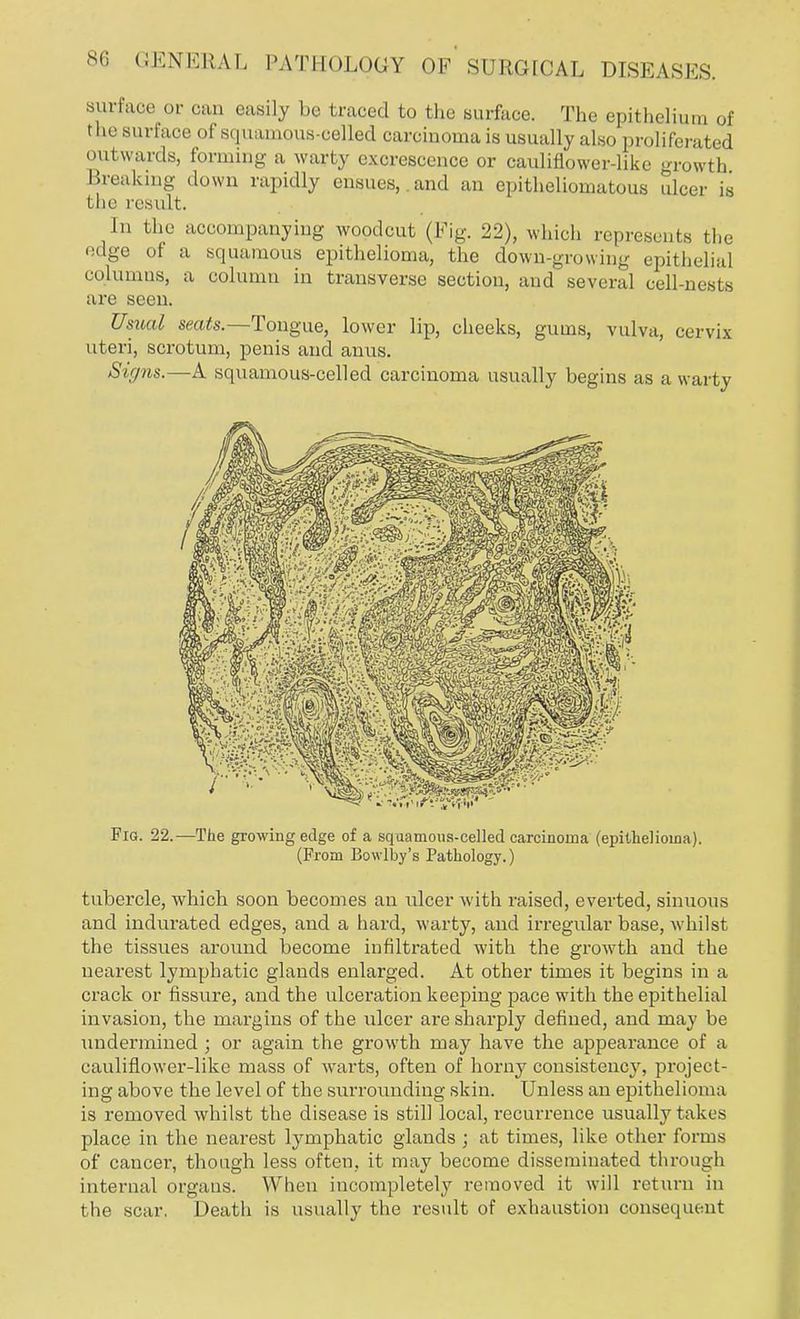surface or can easily be traced to the surface. The epithelium of the surface of squamous-celled carcinoma is usually also proliferated outwards, forming a warty excrescence or cauliflower-like growth Breaking down rapidly ensues,.and an epitheliomatous ulcer is the result. In the accompanying woodcut (Fig. 22), which represents the edge of a squamous epithelioma, the down-growing epithelial columns, a column in transverse section, and several cell-nests are seen. Usual seats.—Tongue, lower lip, cheeks, gums, vulva, cervix uteri, scrotum, penis and anus. Signs.—A squamous-celled carcinoma usually begins as a warty Fig. 22.—The growing edge of a squamous-celled carcinoma (epithelioma). (From Bowlby's Pathology.) tubercle, which soon becomes an ulcer with raised, everted, sinuous and indurated edges, and a hard, warty, and irregular base, whilst the tissues around become infiltrated with the growth and the nearest lymphatic glands enlarged. At other times it begins in a crack or fissure, and the ulceration keeping pace with the epithelial invasion, the margins of the ulcer are sharply defined, and may be undermined; or again the growth may have the appearance of a cauliflower-like mass of warts, often of horny consistency, project- ing above the level of the surrounding skin. Unless an epithelioma is removed whilst the disease is still local, recurrence usually takes place in the nearest lymphatic glands ; at times, like other forms of cancer, though less often, it may become disseminated through internal organs. When incompletely removed it will return in the scar. Death is usually the result of exhaustion consequent