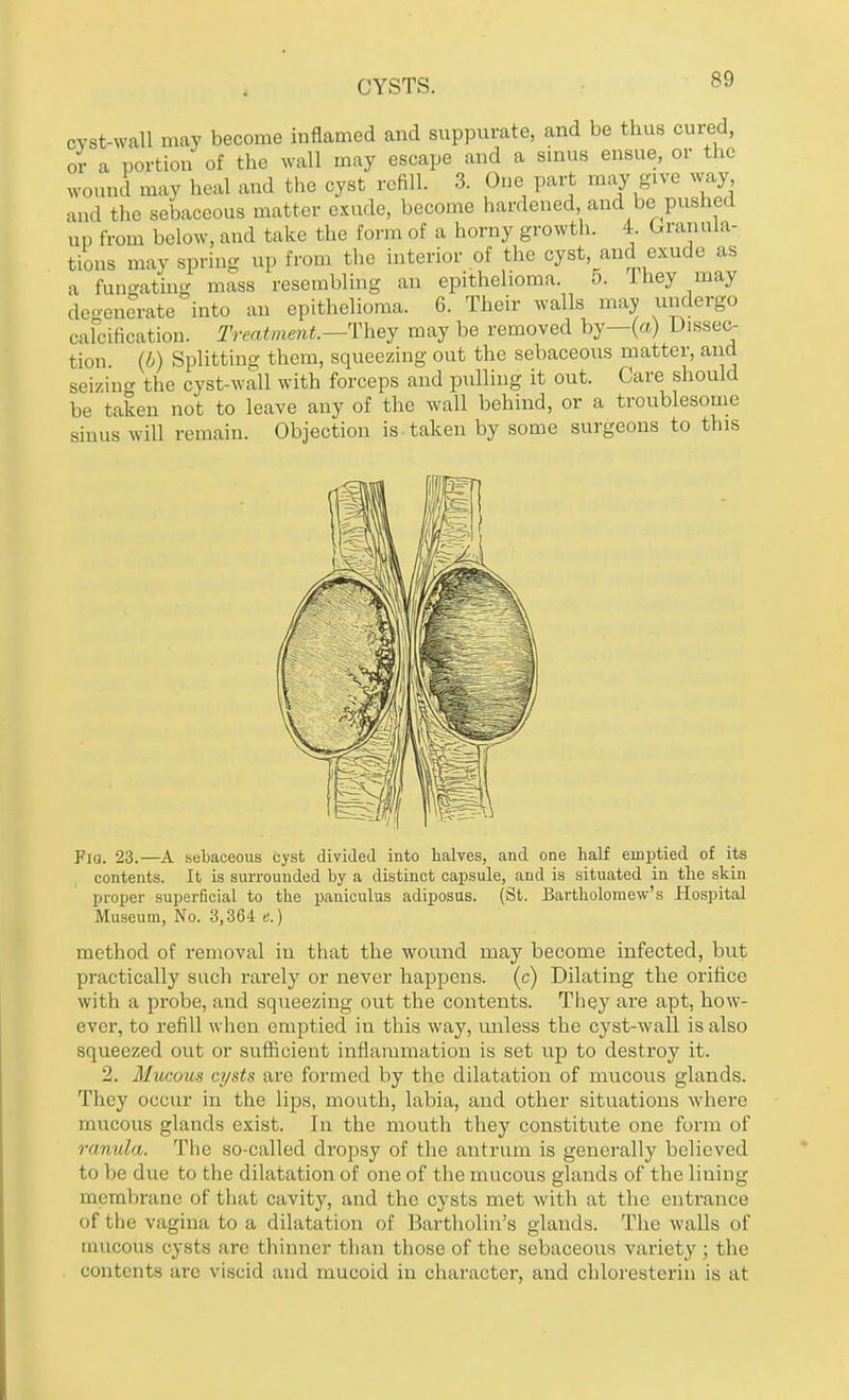 CYSTS. cyst-wall may become inflamed and suppurate, and be thus cured, or a portion of the wall may escape and a sinus ensue, or the W0UJj may heal and the cyst refill. 3. One part may give way and the sebaceous matter exude, become hardened and be pushed up from below, and take the form of a horny growth. 4. granula- tions may spring up from the interior of the cyst and exude as a fungating mass resembling an epithelioma. 5. 1 hey may degenerate into an epithelioma. 6. Their walls may undergo calcification. Treatment.—They may be removed by—{a) Dissec- tion (b) Splitting them, squeezing out the sebaceous matter, and seizin the cyst-wall with forceps and pulling it out. Care should be taken not to leave any of the wall behind, or a troublesome sinus will remain. Objection is taken by some surgeons to this Fia. 23.—A sebaceous cyst divided into halves, and one half emptied of its contents. It is surrounded by a distinct capsule, and is situated in the skin proper superficial to the paniculus adiposus. (St. Bartholomew's Hospital Museum, No. 3,364 e.) method of removal in that the wound may become infected, but practically such rarely or never happens, (c) Dilating the orifice with a probe, and squeezing out the contents. They are apt, how- ever, to refill when emptied in this way, unless the cyst-wall is also squeezed out or sufficient inflammation is set up to destroy it. 2. Mucous cysts are formed by the dilatation of mucous glands. They occur in the lips, mouth, labia, and other situations where mucous glands exist. In the mouth they constitute one form of ranula. The so-called dropsy of the antrum is generally believed to be due to the dilatation of one of the mucous glands of the lining membrane of that cavity, and the cysts met with at the entrance of the vagina to a dilatation of Bartholin's glands. The walls of mucous cysts are thinner than those of the sebaceous variety ; the contents are viscid and mucoid in character, and chloresterin is at