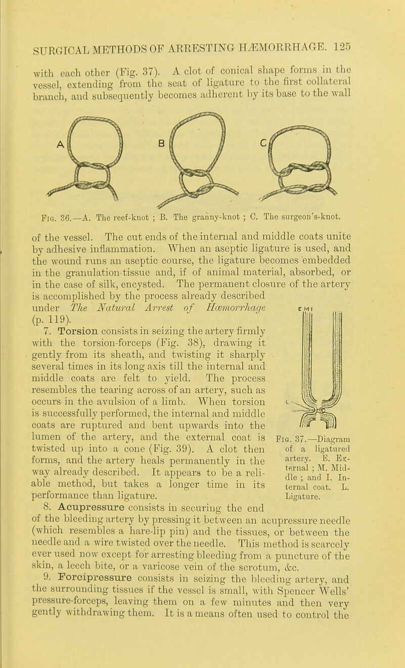 with each other (Fig. 37). A clot of conical shape forms in the vessel, extending from the seat of ligature to the first collateral branch, and subsequently becomes adherent by its base to the wall Fig. 36.—A. The reef-knot ; B. The granny-knot ; C. The surgeon's-knot. of the vessel. The cut ends of the internal and middle coats unite hy adhesive inflammation. When an aseptic ligature is used, and the wound runs an aseptic course, the ligature becomes embedded in the granulation-tissue and, if of animal material, absorbed, or in the case of silk, encysted. The permanent closure of the artery is accomplished by the process already described under The Natural Arrest of Haemorrhage (p. 119). 7. Torsion consists in seizing the artery firmly with the torsion-forceps (Fig. 38), drawing it gently from its sheath, and twisting it sharply several times in its long axis till the internal and middle coats are felt to yield. The process resembles the tearing across of an artery, such as occurs in the avulsion of a limb. When torsion is successfully performed, the internal and middle coats are ruptured and bent upwards into the lumen of the artery, and the external coat is twisted up into a cone (Fig. 39). A clot then forms, and the artery heals permanently in the way already described. It appears to be a reli- able method, but takes a longer time in its performance than ligature. 8. Acupressure consists in securing the end of the bleeding artery by pressing it between an acupressure needle (which resembles a hare-lip pin) and the tissues, or between the needle and a wire twisted over the needle. This method is scarcely ever used now except for arresting bleeding from a puncture of the skin, a leech bite, or a varicose vein of the scrotum, &c. 9. Forcipressure consists in seizing the bleeding artery, and the surrounding tissues if the vessel is small, with Spencer Wells' pressure-forceps, leaving them on a few minutes and then very gently withdrawing them. It is a means often used to control the Fig. 37.—Diagram of a ligatured artery. E. Ex- ternal ; M. Mill- die ; and I. In- ternal coat. L. Ligature.