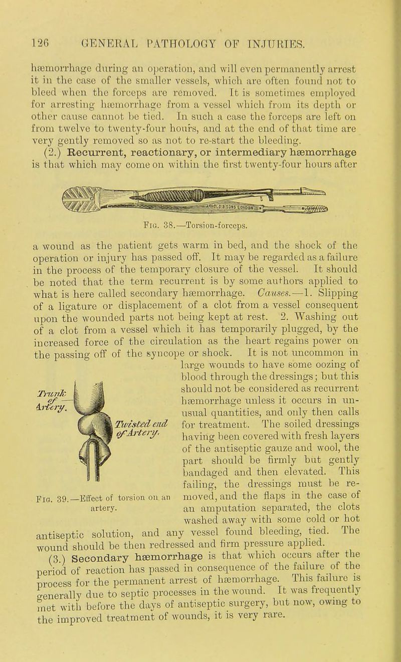 haemorrhage during an operation, and will even permanently arrest it in the ease of the smaller vessels, which are often found not to bleed when the forceps arc removed. It is sometimes employed Eor arresting haemorrhage from a vessel which From its depth or other cause cannot be tied. In such a case the forceps are left on from twelve to twenty-four hours, and at the end of that time are very gently removed so as not to re-start the bleeding. (2.) Recurrent, reactionary, or intermediary haemorrhage is that which may come on within the first twenty-four hours after of — Artery. Fig. 38.—Torsion-forceps. a wound as the patient gets warm in bed, and the shock of the operation or injury has passed off. It may be regarded as a failure in the process of the temporary closure of the vessel. It should be noted that the term recurrent is by some authors applied to what is here called secondary haemorrhage. Causes.—1. Slipping of a ligature or displacement of a clot from a vessel consequent upon the wounded parts not being kept at rest. 2. Washing out of a clot from a vessel which it has temporarily plugged, by the increased force of the circulation as the heart regains power on the passing off of the syncope or shock. It is not uncommon in large wounds to have some oozing of blood through the dressings; but this should not be considered as recurrent hemorrhage unless it occurs in un- usual quantities, and ordy then calls for treatment. The soiled dressings having been covered with fresh layers of the antiseptic gauze and wool, the part should be firmly but gently bandaged and then elevated. This failing, the dressings must be re- moved, and the flaps in the case of au amputation separated, the clots washed away with some cold or hot antiseptic solution, and any vessel found bleeding, tied. The wound should be then redressed and firm pressure applied. (3 ) Secondary haemorrhage is that which occurs after the period of reaction has passed in consequence of the failure of the process for the permanent arrest of haemorrhage. This failure is generally due to septic processes in the wound. It was frequently met witli before the days of antiseptic surgery, but now, own.- to the improved treatment of wounds, it is very rare. Ttvislecl end ofAi'tery. FlO. 39.—Effect of torsion on an artery.