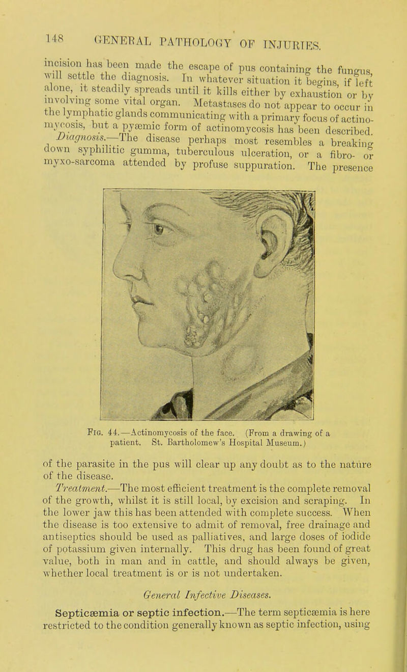 incision has been made the escape of pus containing the fungus will settle the diagnosis. In whatever situation it begins if left alone, it steadily spreads until it kills either by exhaustion or by involving some vital organ. Metastases do not appear to occur in the lymphatic glands communicating with a primary focus of actino- mycosis, but a pyuemic form of actinomycosis has been described Diagnosis.—The disease perhaps most resembles a breaking down syphilitic gumma, tuberculous ulceration, or a fibro- or mwo-sarcoma attended by profuse suppuration. The presence 7 Fig. 44.—Actinomycosis of the face. (Prom a drawing of a patient. St. Bartholomew's Hospital Museum.) of the parasite in the pus will clear up any doubt as to the nature of the disease. Treatment.—The most efficient treatment is the complete removal of the growth, whilst it is still local, by excision and scraping. In the lower jaw this has been attended with complete success. When the disease is too extensive to admit of removal, free drainage and antiseptics should be used as palliatives, and large doses of iodide of potassium given internally. This drug has been found of great value, both in man and in cattle, and should always be given, whether local treatment is or is not undertaken. General Infective Diseases. Septicaemia or septic infection.—The term septicaemia is here restricted to the condition generally known as septic infection, using