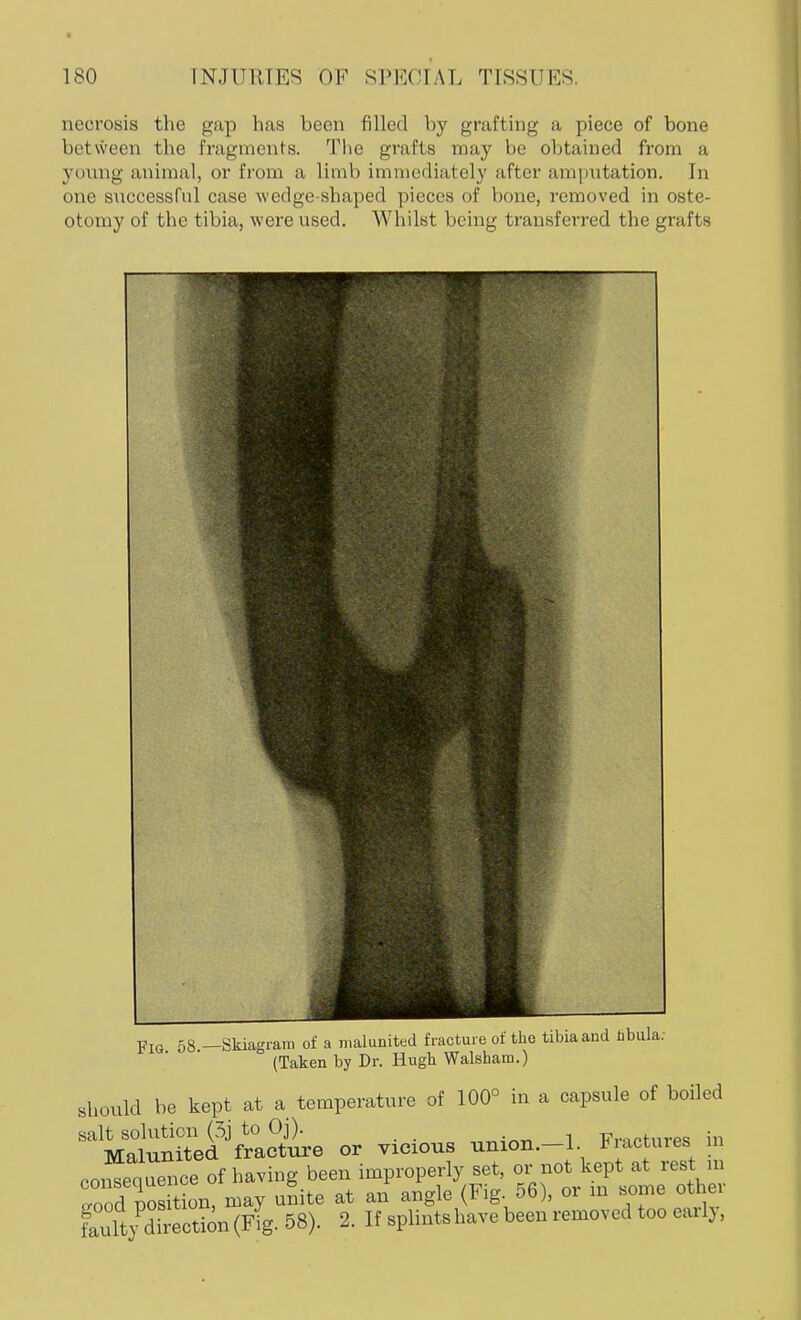necrosis the gap has been filled by grafting a piece of bone between the fragments. The grafts may be obtained from a young animal, or from a limb immediately after amputation. In one successful case wedge-shaped pieces of bone, removed in oste- otomy of the tibia, were used. Whilst being transferred the grafts FlG 58 —Skiagram of a malunited fracture of the tibia and bbula. (Taken by Dr. Hugh Walshara.) should be kept at a temperature of 100° in a capsule of boiled salt solution (3j to Oj). iswtnrps in Malunited fracture or vicious union.—1. liactuies in «Jsw^nce of having been improperly set, or not kept at rest m loHSon! may unite at an angle (Fig. 56), or in some other S^ySeSten (Fig- 58)- 2. H splintshave been removed too early,