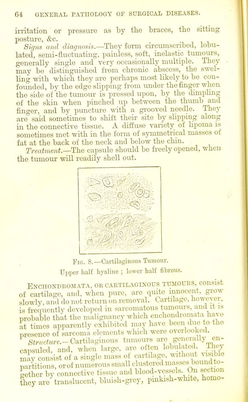 ii-ritation or pressure as by the braces, the sitting posture, &c. Signs and cUarjnnsis.—T'heY form cLrcumscribed, lobu- lateci, semi-fluctuatmg, painless, soft, inelastic tumours, generally single and very occasionally multiple. They may be distinguished from chronic abscess, the swel- ling with which they are perhaps most likely to be con- founded, by the edge slipping from under the finger when the side of the tumour is pressed upon, by the dimpling of the skin when pinched up between the thumb and finger, and by puncture with a grooved needle. They are said sometimes to sliift their site by slippmg along in the connective tissue. A diffuse variety of lipoma is^ sometimes met with in the form of symmetrical masses of fat at the back of the neck and below the chm. Treatment—The capsule should be freely opened, when the tumour will readily shell out. \ Pig. 8.—Cartilaginous Tumoiu-. Upper half layaline ; lower half fibrous. ENCnONlDROMATA, OR C.VRTILAGCs OUS TUMOURS COnsist of cartilage, and, when piu-e, are qmte muoeent, grow slowly, and do not return on removal. Cartilage, however, is frequently dovelopc.l in sarcomatous tumours, and it is in-obable that the muHgnancy wliich euchonili-omata have it times appar.mtly exliilntcd may have been duo to the nrosonco of sarcoma elements which were overlooked. S<r»rf«re.-Cartilaginous tmnours are generally en- capsuled, and, wlien large, are oltcn lobu ated. Thoj miy eon ist of a single mass of cartilage, without ^1Slblo ™rtiti.)ns, or of nimierous s.nall clustered ma^sses boundto- ge her by connective tissue and blood-vessels On section they are^ranslucent, bluish-grey, pinkish-white, homo-