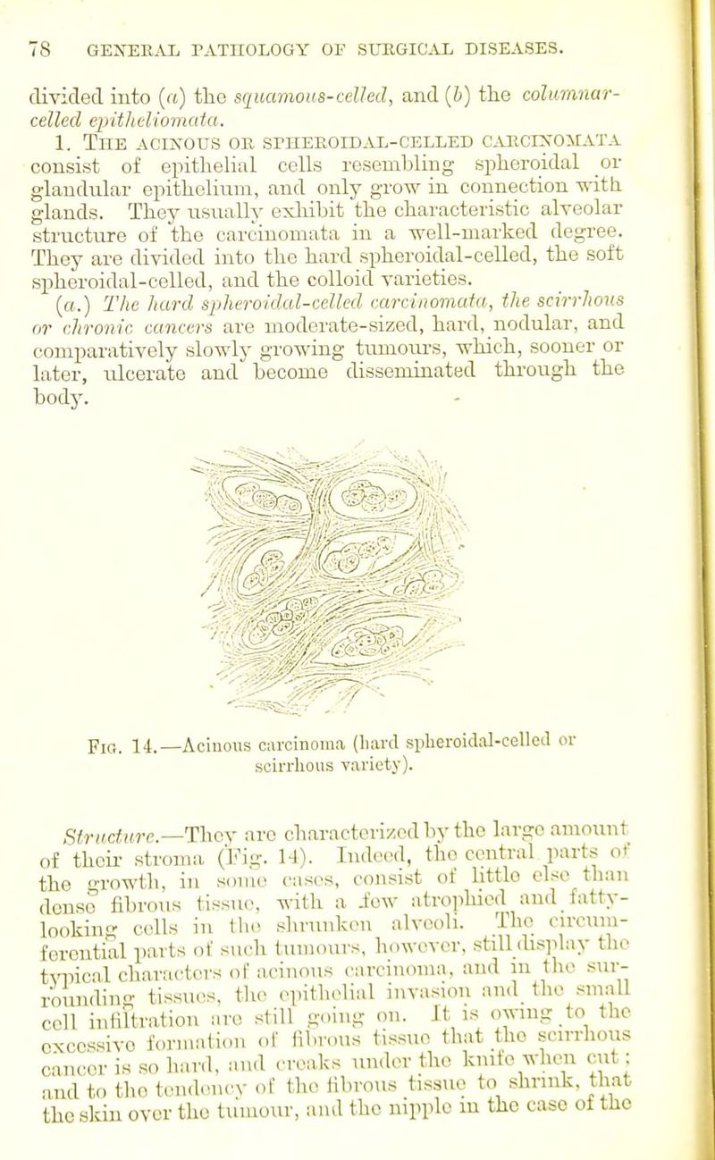 divided into (a) the squamous-celled, and {b) the columnar- celled epitlteliomata. 1. The acinous ok SrHEEOID.Vi-CELLED CVECIXOiLVTA consist of epithelial cells resembling spheroidal or glandular epithelium, and only grow in connection with glands. They usually exhibit the chai'acteristic alveolar structure of the carcinomata in a well-marked degree. They are divided into the hard spheroidal-celled, the soft spheroidal-celled, and the colloid varieties. (a.) The hard spheroidal-celled carcinomata, the scirrhous or chronic cancers are moderate-sized, hard, nodular, and comparatively slowly growing tumours, which, sooner or later, ulcerate and become disseminated through the body. Fia. 14.—Acinous curoinoma (hard spheroidal-celled or scirrhous variety). Sir ndnre—They are characterized bv the largo amount of theii- stroma, (Vvj;. U). Indeed, the central parts of the Towth, in some cases, consist of little else than dense fibrous tissue, with a .few atrophied and fatty- looking cells in the shrunken alveoli. The circum- ferential parts of such tumoiu's, however, still display the tvpical characters of acinous carcinoma, and m the sur- rounding tissue's, tlie .-pitli'^li^ invasion and_ the smaU cell inlVltration are still going on. It is owing to the excessive formation of fibrous tissue that the .scirrhous cancer is so hard, and creaks under the knife when cut: and tf) the tendenev of the fibrous tissue to shrink, that the skiu over the tumour, and the nipple in the case of the