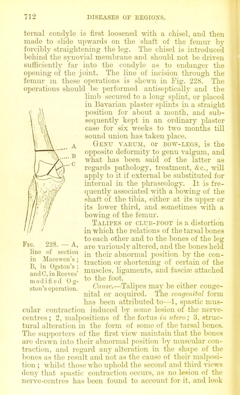 ternal condyle is first loosened with a chisel, and then made to slide upwards on the shaft of the femur hy forcibly straightening the log. The chisel is introduced behind the sjaiovial membrane and should not be driven sufficiently far into the condjde as to endanger the oj^ening of tho joint. The line of incision through the femur m these operations is shc^ra in Fig. 228. The operations should be performed antiseptically and the limb secm'ed to a long sjilint, or placed in bavarian plaster splints in a straight position for about a month, and sub- sequentlj^ kept in an ordinary plaster case for six weeks to two months till sound imion has taken place. G-ETvU YAHUM, 01 BOW-LEGS, is the opposite deformity to genu valgum, and what has been said of the latter as regards pathology, treatment, itc, will ajjply to it if external be substituted for internal in the phi'aseology. It is fre- quent!}^ associated vrith. a bowing of the shaft of the tibia, either at its upper or its lower third, and sometimes with a bowing of the femur. Talipes or club-foot is a distortion in which the relations of the tarsal bones to each other and to the bones of the leg are variously altered, and the bones held in their- abnormal position by the con- ti'action or shortening of certain of the muscles B . C ■■'1 ''^'m Fig. 228. — A, lino of section in Macewen's ; B, in Ogston's : andC, in Reeves' modified 0 g- ston's operation. ligaments, and fascia) attached to the foot. Ca use.—Talipes may be either conge- nital or acquired. The congenital form has been attributed to—1, spastic mus- cular contraction induced by some lesion of the ncrvo- contres; 2, malpositions of the fa>tus tifero; 3, struc- tui-al alteration in the form of some of tho tarsal bones. Tho supporters of the first view maintain that tho bones art^ drawn into tlieir abnormal position by muscular con- traction, and regard any tdtoratiou in the shape of the bones as tlie result and not as the cause of their malposi- tion ; whilst those who ujihold tho second and third views deny that spastic contracti(jn occiu'S, as no lesion of tho nerve-centres has been found to account for it, and look