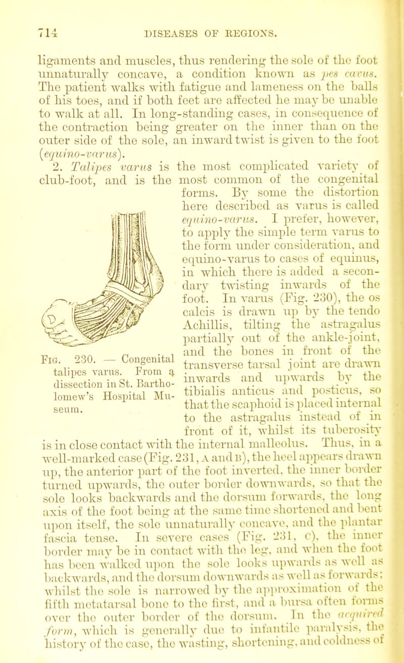 'Z. Talipes varus is club-foot, and is the ligaments and muscles, thus rendering the solo of the foot unnaturally concave, a condition known as ^ics rariin. The patient walks with fatigue and lameness on the halln of his toes, and if both feet are affected he may be unable to walk at all. In long-standing cases, in consequence of the contraction being greater on the inner than on the outer side of the sole, an inward twist is given to the foot {equino-va7'us). the most complicated A^ariety of most common of the congenital forms. By some the distortion here described as varus is called eqiiino-varus. I prefer, however, to apply the simple term varus to the form under consideration, and equino-varus to cases of equinus, ia which there is added a secon- dary t-wdsting inwards of thi' foot. In varus (Fig. 230), the os calcis is drawn up by the tendo Achillis, tnting the astragalus partially out of the ankle-joint, and the bones in fi-ont of the transverse tarsal joint are drawn inwards and upwards by the tibialis anticus and posticus, so that the scaphoid is placed internal to the astragalus instead of ui front of it, whilst its tuberositA' is in close contact with the internal malleolus. Thus, in a well-marked case (Fig. 231, A audii), the heel appears drawn up, the anterior part'of the foot inverted, the inner border turned upwards, the outer border downwards, so that the sfde looks backwards and the dorsum forwards, the long axis of the foot being at the s;imc time sliorteued and bout Tipon itself, the solo imnaturally concave, and the plantar fascia tense. In severe cases (Fig. 231, c), the inner border may be in contact with the leg, and when the foot has been walked u]ion the sole looks upwards as well as backwards, and the dorsum downwards as well as forwards: whilst the sole is narrowed by the aiiiiroximation of the fifth metatarsal bone to the hrst, and a bursa often forms over the outer border of the dorsum. In the aajimrd fvnn, which is generallv due to infantile paralysis, the history of tlic case, the wasting, shortening, and coldness ot Fig. 230. — Congenital talipes varus. From dissection in St. Bartho- lomew's Hospital Mu- seum.