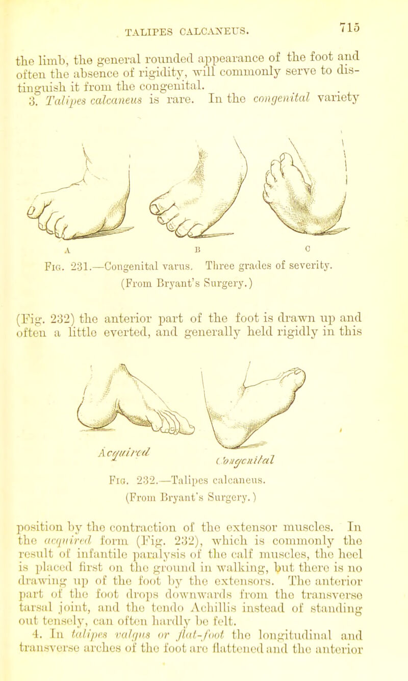 TALIPES CALC.\:XEI'S. the limb, the general rounded appearance of the foot and often the absence of rigidity, will commonly serve to dis- tinguish it from the congenital, o. Talipes calcaneus is rare. In the congenital varietj^ A B C Fig. 231.—Congenital varus, Tln-ee grades of severity. (From Bryant's Surgery.) (Eig. 232) the anterior part of the foot is drawn up and often a httlo everted, and generally held rigidly in this Fic. •232.—Talipes calcaneus. (From Bryant's Surgery.) position by the contraction of the extensor mviscles. In the ucqitircd form (Fig. 2;32), which is commonly the result of infantile paralysis of the calf muscles, the heel is placed first on the ground in walking, but there is no drawing up of the foot by the extensors. The a,nterior part of the foot drops downwards from the tran.sverse tarsal joint, and the tondo Achillis instead of standing out ten.soly, can often hardly be felt. 4. In talipes valgus or flat-foot the longitudinal and tran.sverse arches of the foot are flattened and the anterior