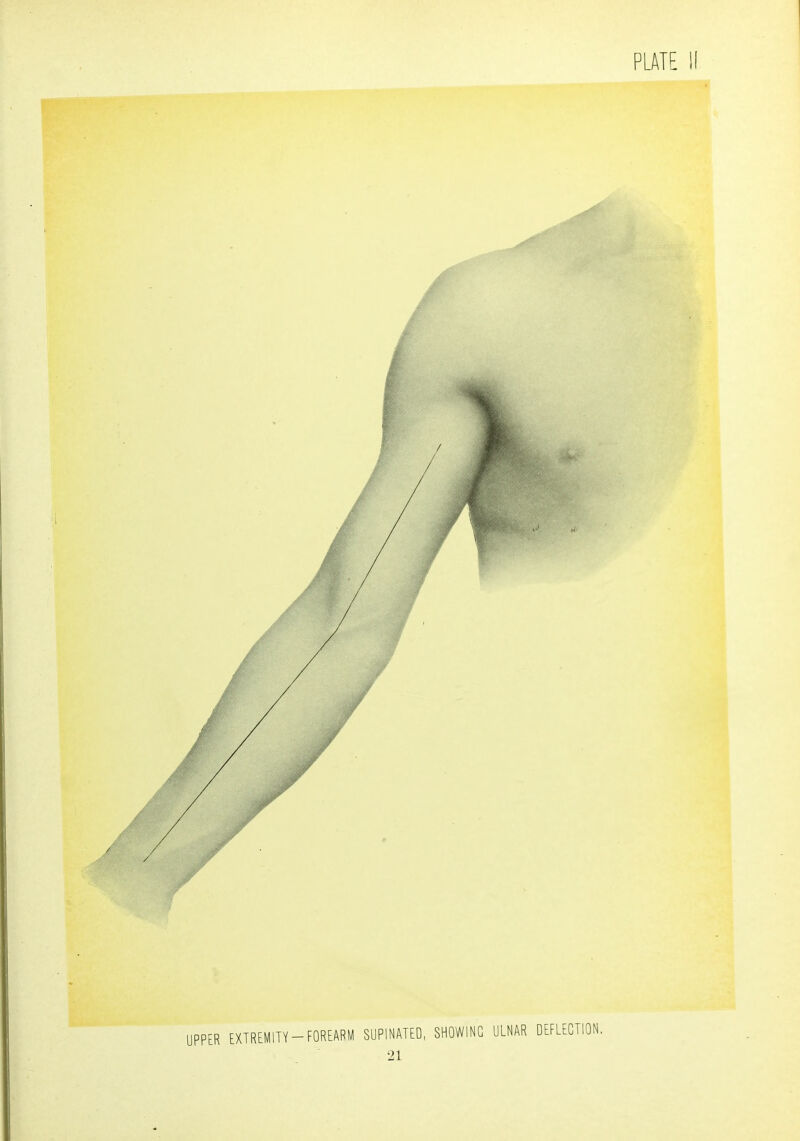 EXTREMITY-FOREARM SUPINATED, SHOWING ULNAR DEFLECTION.