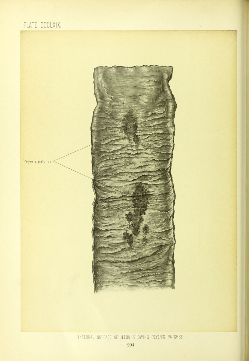 1 PLATE CCCLXIX, INTERNAL SURFACE OF ILEUM SHOWING PEYER'S PATCHES.