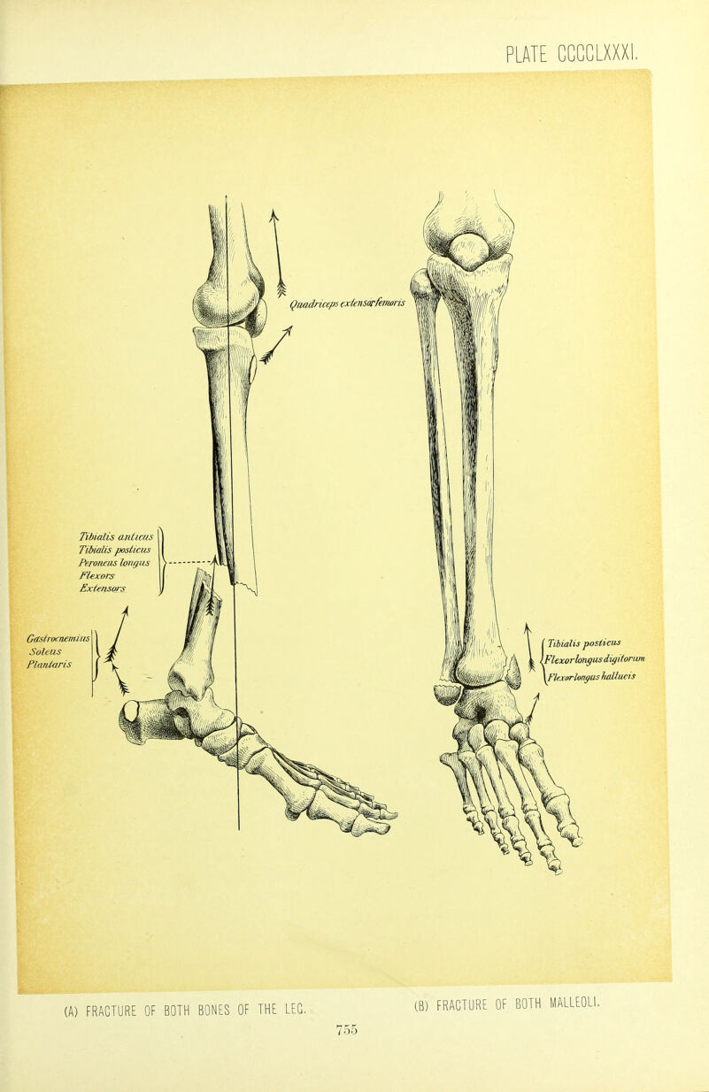 (A) FRACTURE OF BOTH BONES OF THE LEG, (B) FRACTURE OF BOTH MALLEOLI.