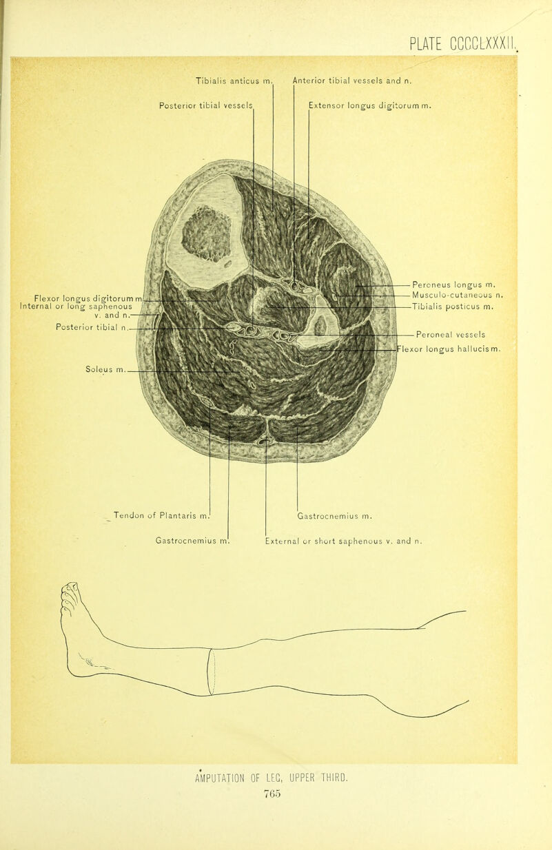 AMPUTATION OF LEG, UPPER THIRD,