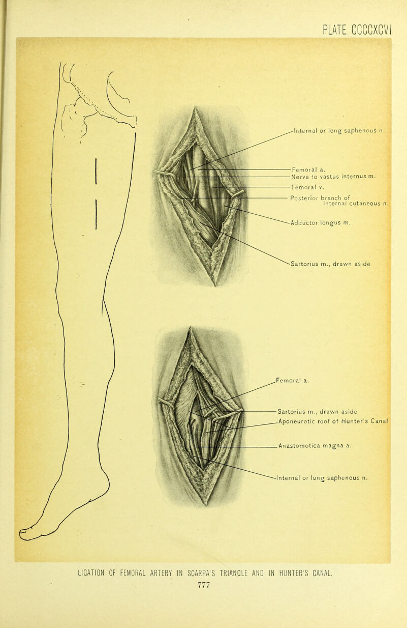 LIGATION OF FEMORAL ARTERY IN SCARPA'S TRIANGLE AND IN HUNTER'S CANAL.