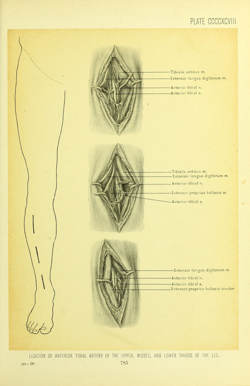 LIGATION OF ANTERIOR TIBIAL ARTERY IN THE UPPER, MIDDLE, AND LOWER THIRDS OF THE LEG. 50 7 85