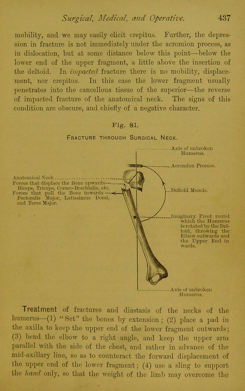 mobility, and we may easily elicit crepitus. Further, the depres- sion in fracture is not immediately under the acromion process, as in dislocation, but at some distance below this point—below the lower end of the u^jper fragment, a little above the insertion of the deltoid. In invpaded fracture there is no mobility, displace- ment, nor crepitus. In this case the lower fragment usually penetrates into the cancellous tissue of the superior—the reverse of impacted fracture of the anatomical neck. The signs of this condition arc obscure, and chiefly of a negative character. Fig. 81. Fracture through Surgical Neck. jVuiitomiciU Xcck Forces that disiiliicc the Uoue upwards—<■— Biceps, Tiicep.s, Coinco-BracUialis, etc. Forces that pull the Bone inwards — Pectoralis Jlajor, Latissiiuus Dorsi, and Teres Major. Axis of unbroken Humerus. Acromion Proce.s.s. Deltoid Mu.scle. Imaginary Pivot round which the Humerus is rotated by the Del- toid, throwing the Klbow outwai-ds and the Upper End in wards. Axis of unbroken Hvuuerus. Treatment of fractures and diastasis of the necks of the humeru-s—(1) Set the bones by extension; (2) place a pad in the axilla to keep the upper end of the lower fragment outwards; (3) bend the elbow to a riglit angle, and keep the uj^per arm parallel witli the side of the chest, and rather in advance of the mid-axillary line, so as to counteract the forward displacement of the upper end of the lower fragment; (4) use a sling to support the hand only, so that the weight of the limb may overcome tho