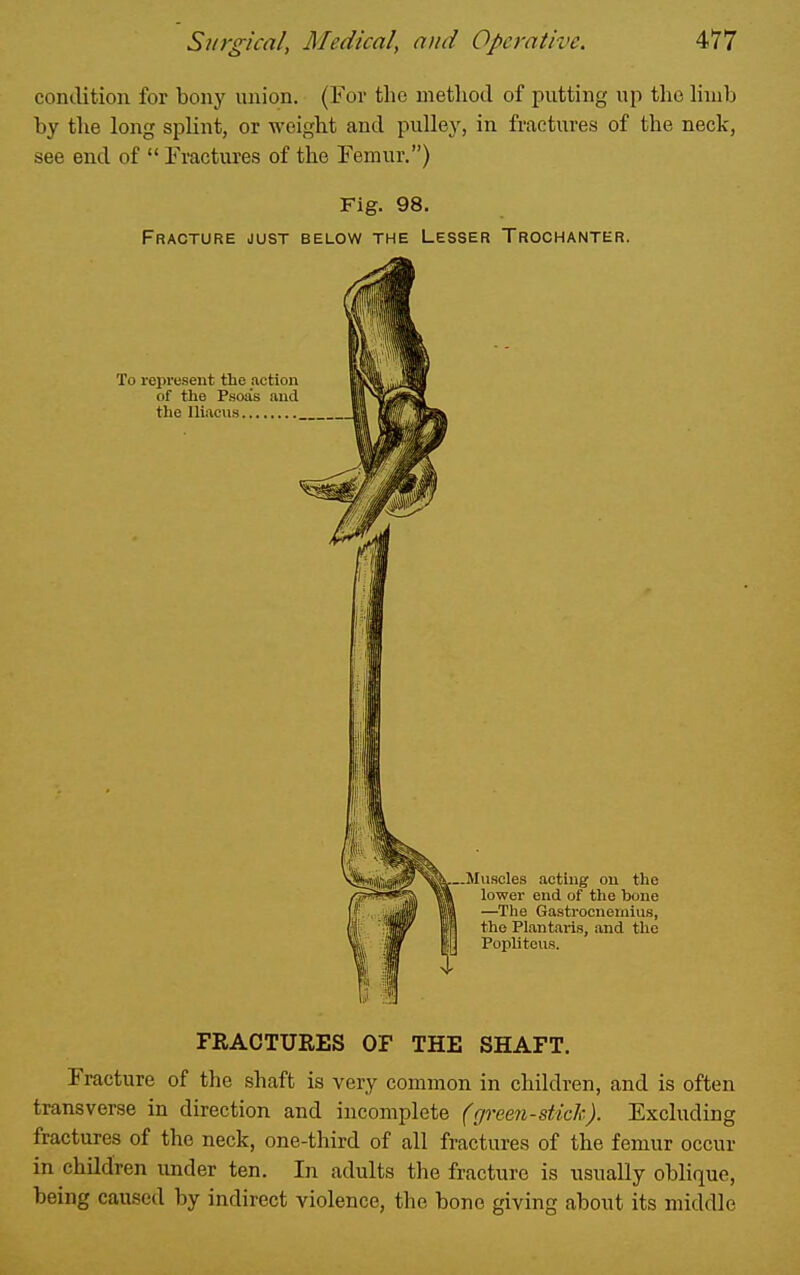 comlition for bony union. (For the method of putting up the Hnib by the long splint, or weight and pulley, in fractures of the neck, see end of  Fractures of the Femur.) Fig. 98. Fracture just below the Lesser Trochanter. To represent the action of the Psoas and the Uiacus FRACTURES OF THE SHAFT. Fracture of the shaft is very common in children, and is often transverse in direction and incomplete (green-sticlc). Excluding fractures of the neck, one-third of all fractures of the femur occur in children under ten. In adults the fracture is usually oblique, being caused by indirect violence, the bone giving about its middle