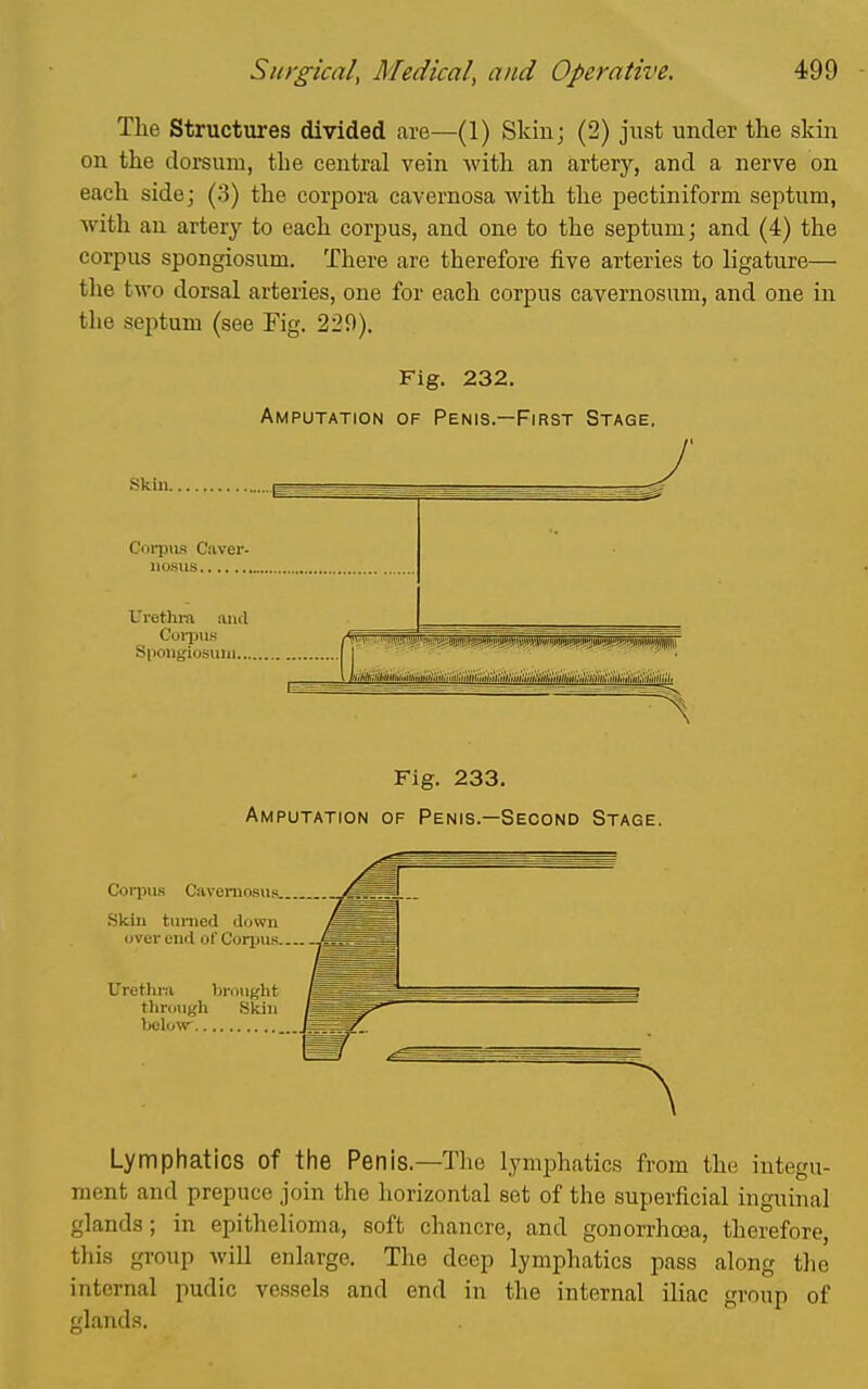 The Structures divided are—(1) Skin; (2) just under the skin on the dorsum, the central vein with an artery, and a nerve on each side; (3) the corpora cavernosa with the pectiniform septum, with an artery to each corpus, and one to the septum; and (4) the corpus spongiosum. There are therefore five arteries to ligature— the two dorsal arteries, one for each corpus cavernosum, and one in the septum (see Fig. 220). Fig. 232. Amputation of Penis.—First Stage. Skiu Corpus Caver, iiosus Uvethro aud Spongiosum I ' ' ' ' ■ Fig. 233. Amputation of Penis.—Second Stage. Coi-pus Caveniosus. Skin turned down over end of Corpus. Urethra brought through Skin bolow Lymphatics of the Penis.—The lymphatics from the integu- ment and prepuce join the horizontal set of the superficial inguinal glands; in epithelioma, soft chancre, and gonorrhosa, therefore, this group will enlarge. The deep lymphatics pass along the internal pudic vessels and end in the internal iliac group of glands.