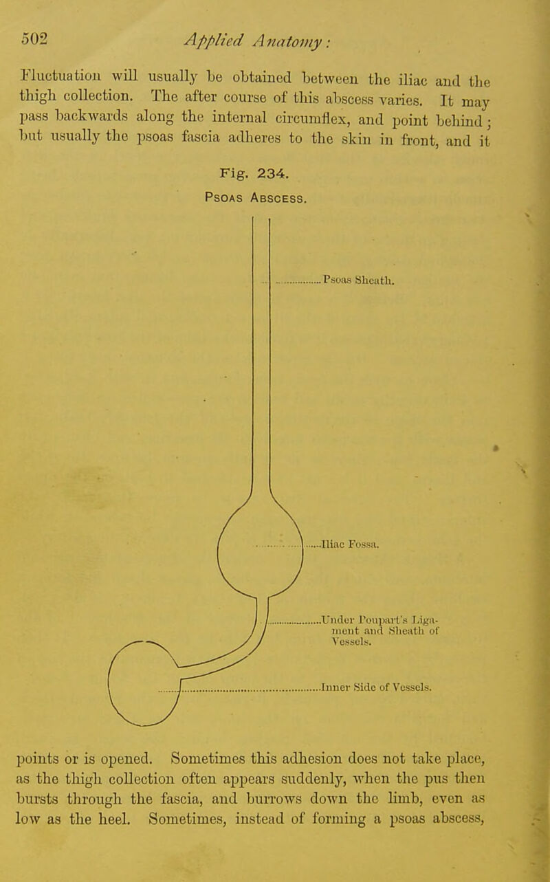 Fluctuation will usually be obtained between the iliac and llie thigh collection. The after course of this abscess varies. It may pass backwards along the internal circumflex, and point behind; but usually the psoas fascia adheres to the skin in front, and it Fig. 234. Psoas Abscess. Psoas Sheath. Iliac Fossa. X'ndur IVniiiart's Liga- iiieut and Sheath of Vessels. .Inner Side of Vessels. points or is opened. Sometimes this adhesion does not take place, as the thigh collection often appears suddenly, when the pus tlien bursts through the fascia, and buiTows down the limb, even as low as the heel. Sometimes, instead of forming a psoas abscess.