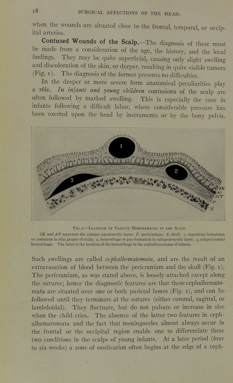 when the wounds are situated close to the frontal, temporal, or occip- ital arteries. Contused Wounds of the Scalp.-The diagnosis of these must be made from a consideration of the age, the history, and the local findings. They may be quite superficial, causing only slight swclhng and discoloration of the skin, or deeper, resulting in quite visible tumors (Fig. i). The diagnosis of the former presents no difficulties. In the deeper or more severe form anatomical pecuHarities play a r61e. In infants and young children contusions of the scalp are often followed by marked swelling. This is especially the case in infants following a difficult labor, where considerable pressure has been exerted upon the head by instruments or by the bony pelvis. Fig. I.—Location of Various Hemorrhages in the Scalp. 5X and .4/ represent the cutaneo-aponeurotic layer; P, pericranium; 5, skull; i, superficial hematoma or contusion in skin proper of scalp; 2, hemorrhage or pus-formation in subaponeurotic layer; 3, subpericranial hemorrhage. The latter is the location of the hemorrhage in the cephalhematoma of infants. Such swellings are called cephalhematomata, and are the result of an extravasation of blood between the pericranium and the skull (Fig. i). The pericranium, as was stated above, is loosely attached except along the sutures; hence the diagnostic features are that these cephalhemato- mata are situated over one or both parietal bones (Fig. 2), and can be followed until they terminate at the sutures (either coronal, sagittal, or lambdoidal). They fluctuate, but do not pulsate or increase in size when the child cries. The absence of the latter two features in ceph- alhematomata and the fact that meningoceles almost always occur in the frontal or the occipital region enable one to differentiate these two conditions in the scalps of young infants. At a later period (four to six weeks) a zone of ossification often begins at the edge of a ceph-