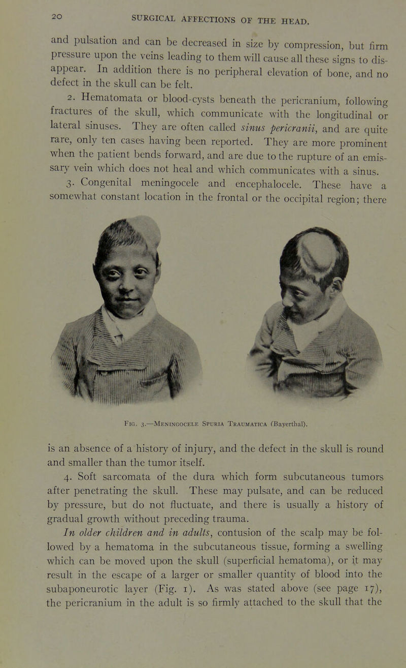 and pulsation and can be decreased in size by compression, but firm pressure upon the veins leading to them will cause all these signs to dis- appear. In addition there is no peripheral elevation of bone, and no defect in the skull can be felt. 2. Hematomata or blood-cysts beneath the pericranium, following fractures of the skull, which communicate with the longitudinal or lateral sinuses. They are often called sinus pericranii, and are quite rare, only ten cases having been reported. They are more prominent when the patient bends forward, and are due to the rupture of an emis- sary vein which does not heal and which communicates with a sinus. 3. Congenital meningocele and encephalocele. These have a somewhat constant location in the frontal or the occipital region; there Fig. 3.—Meningocele Spuria Traumatica (Bayerthal). is an absence of a histoiy of injury, and the defect in the skull is round and smaller than the tumor itself. 4. Soft sarcomata of the dura which form subcutaneous tumors after penetrating the skull. These may pulsate, and can be reduced by pressure, but do not fluctuate, and there is usually a history of gradual growth without preceding trauma. In older children and in adults, contusion of the scalp may be fol- lowed by a hematoma in the subcutaneous tissue, forming a swelling which can be moved upon the skull (superficial hematoma), or it may result in the escape of a larger or smaller quantity of blood into the subaponeurotic layer (Fig. i). As was stated above (see page 17), the pericranium in the adult is so firmly attached to the skull that the