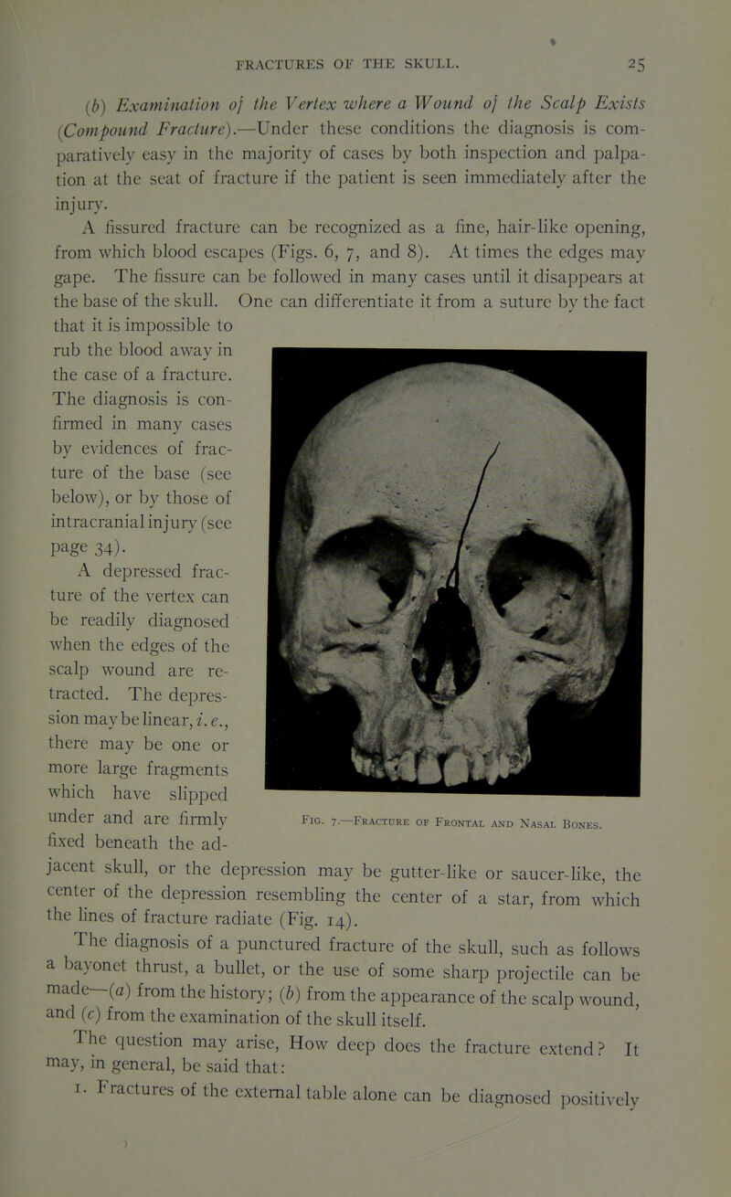 (b) Examination oj the Vertex where a Wound oj the Scalp Exists (^Compound Fracture).—Under these conditions the diagnosis is com- paratively easy in the majority of cases by both inspection and palpa- tion at the seat of fracture if the patient is seen immediately after the injury. A fissured fracture can be recognized as a fine, hair-like opening, from which blood escapes (Figs. 6, 7, and 8). At times the edges may gape. The fissure can be followed in many cases until it disappears at the base of the skull. One can differentiate it from a suture by the fact that it is impossible to rub the blood away in the case of a fracture. The diagnosis is con- firmed in many cases by evidences of frac- ture of the base (see below), or by those of intracranial injury (see page 34). A depressed frac- ture of the vertex can be readily diagnosed when the edges of the scalp wound are re- tracted. The depres- sion maybe linear, i. e., there may be one or more large fragments which have shpped under and are firmly fixed beneath the ad- jacent skull, or the depression may be gutter-hke or saucer-like, the center of the depression resembhng the center of a star, from which the lines of fracture radiate (Fig. 14). The diagnosis of a punctured fracture of the skull, such as follows a bayonet thrust, a bullet, or the use of some sharp projectile can be made—(a) from the history; (b) from the appearance of the scalp wound, and (c) from the examination of the skull itself. The question may arise. How deep does the fracture extend? It may, in general, be said that: I. Fractures of the external table alone can be diagnosed positively Fig. 7.--FRACTURE of Frontal and Nasal Bones.