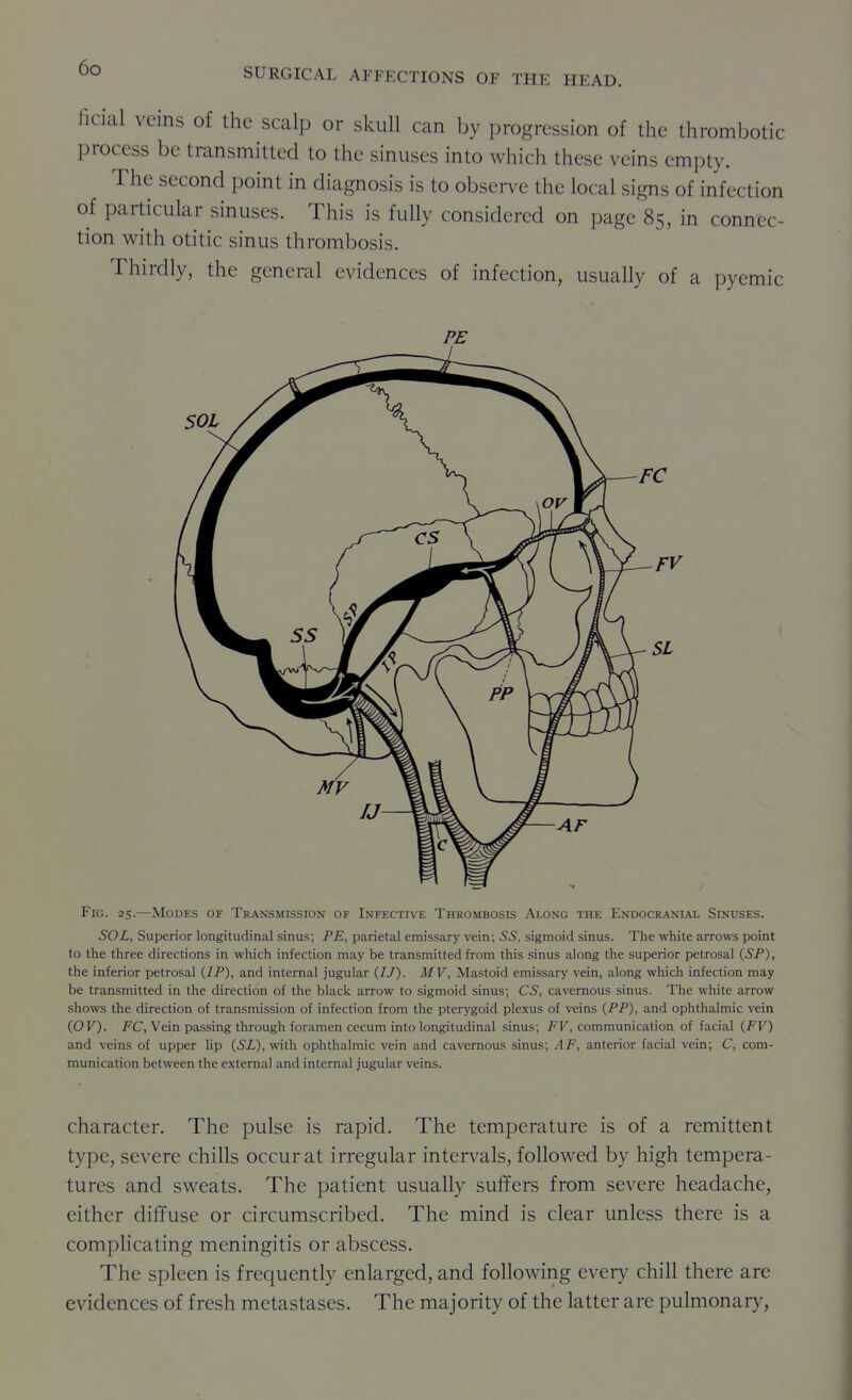 ficial veins of the scalp or skull can by progression of the thrombotic process be transmitted to the sinuses into which these veins empty. The second point in diagnosis is to observe the local signs of infection of particular sinuses. This is fully considered on page 85, in connec- tion with otitic sinus thrombosis. Thirdly, the general evidences of infection, usually of a pyemic Fig. 25.—Modes of Transmission of Infective Thrombosis Along the Endocranial Sinuses. SOL, Superior longitudinal sinus; PE, parietal emissary vein; 55, sigmoid sinus. The white arrows point to the three directions in which infection may be transmitted from this sinus along the superior petrosal (5P), the inferior petrosal {IP), and internal jugular (77). MV, Mastoid emissary vein, along which infection may be transmitted in the direction of the black arrow to sigmoid sinus; CS, cavernous sinus. The white arrow shows the direction of transmission of infection from the pterygoid plexus of veins {PP), and ophthalmic vein (07). FC, Vein passing through foramen cecum into longitudinal sinus; FV, communication of facial {FV) and veins of upper Up {SL), with ophthalmic vein and cavernous sinus; AF, anterior facial vein; C, com- munication between the external and internal jugular veins. character. The pulse is rapid. The temperature is of a remittent type, severe chills occur at irregular intervals, followed by high tempera- tures and sweats. The patient usually suffers from severe headache, either diffuse or circumscribed. The mind is clear unless there is a comphcating meningitis or abscess. The spleen is frequently enlarged, and following every chill there are evidences of fresh metastases. The majority of the latter are pulmonar}^.