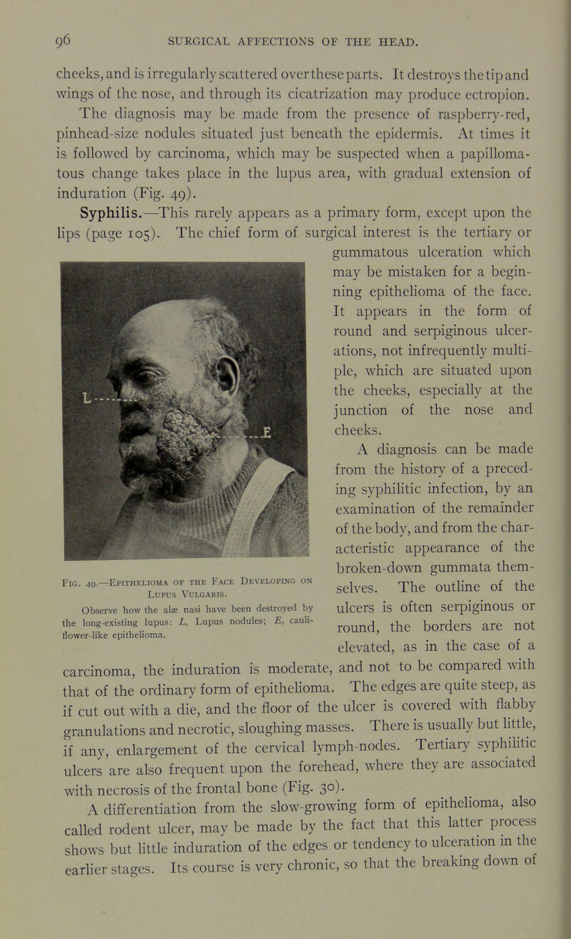 cheeks,and is irregularly scattered over these parts. It destroys thetipand wings of the nose, and through its cicatrization may produce ectropion. The diagnosis may be made from the presence of raspberry-red, pinhead-size nodules situated just beneath the epidermis. At times it is followed by carcinoma, which may be suspected when a papilloma- tous change takes place in the lupus area, with gradual extension of induration (Fig. 49). Syphilis.—^This rarely appears as a primary form, except upon the lips (page 105). The chief form of surgical interest is the tertiary or gummatous ulceration which may be mistaken for a begin- ning epithelioma of the face. It appears in the form of round and serpiginous ulcer- ations, not infrequently multi- ple, which are situated upon the cheeks, especially at the junction of the nose and cheeks. A diagnosis can be made from the history of a preced- ing syphihtic infection, by an examination of the remainder of the body, and from the char- acteristic appearance of the broken-down gummata them- selves. The outline of the ulcers is often serpiginous or round, the borders are not elevated, as in the case of a carcinoma, the induration is moderate, and not to be compared with that of the ordinary form of epithehoma. The edges are quite steep, as if cut out with a die, and the floor of the ulcer is covered with flabby granulations and necrotic, sloughing masses. There is usually but little, if any, enlargement of the cervical lymph-nodes. Tertiary syphilitic ulcers are also frequent upon the forehead, where they are associated with necrosis of the frontal bone (Fig. 30). A differentiation from the slow-growing form of epithelioma, also called rodent ulcer, may be made by the fact that this latter process shows but little induration of the edges or tendency to ulceration m the earner stages. Its course is very chronic, so that the breaking down of Fig. 49.—Epithelioma or the Face Developing on Lupus Vulgaris. Observe how the ate nasi have been destroyed by the long-existing lupus: L, Lupus nodules; E, cauli- flower-like epithelioma.