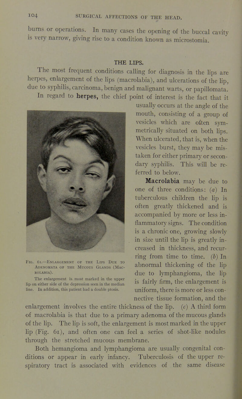 bums or operations. In many cases the opening of tlie buccal cavity is very narrow, giving rise to a condition known as microstomia. THE LIPS. The most frequent conditions caUing for diagnosis in the Hps are herpes, enlargement of the Hps (macrolabia), and ulcerations of the Hp, due to syphiHs, carcinoma, benign and mahgnant warts, or papillomata. In regard to herpes, the chief point of interest is the fact that it usually occurs at the angle of the mouth, consisting of a group of vesicles which are often sym- metrically situated on both Hps. When ulcerated, that is, when the vesicles burst, they may be mis- taken for either primary or secon- dary syphiHs. This will be re- ferred to below. Macrolabia may be due to one of three conditions: (a) In tuberculous children the Hp is often greatly thickened and is accompanied by more or less in- flammatory signs. The condition is a chronic one, growing slowly in size until the Hp is greatly in- creased in thickness, and recur- ring from time to time, (b) In abnormal thickening of the Hp due to lymphangioma, the Hp is fairly firm, the enlargement is uniform, there is more or less con- nective tissue formation, and the enlargement involves the entire thickness of the Hp. (c) A third form of macrolabia is that due to a primary adenoma of the mucous glands of the Hp, The lip is soft, the enlargement is most marked in the upper Hp (Fig. 6i), and often one can feel a series of shot-Hke nodules through the stretched mucous membrane. Both hemangioma and lymphangioma are usually congenital con- ditions or appear in early infancy. Tuberculosis of the upper re- spiratory tract is associated with evidences of the same disease Fig. 6i.—Enlargement of the Lips Due to Adenomata of the Mucous Glands (Mac- rolabia). The enlargement is most marked in the upper lip on either side of the depression seen in the median line. In addition, this patient had a double ptosis.