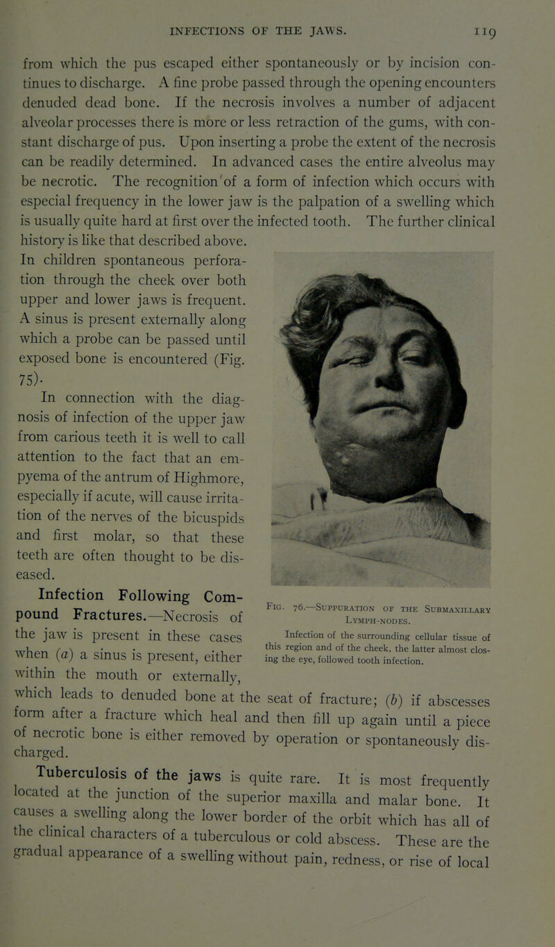 from which the pus escaped either spontaneously or by incision con- tinues to discharge. A fine probe passed through the opening encounters denuded dead bone. If the necrosis involves a number of adjacent alveolar processes there is more or less retraction of the gums, with con- stant discharge of pus. Upon inserting a probe the extent of the necrosis can be readily determined. In advanced cases the entire alveolus may be necrotic. The recognition'of a form of infection which occurs with especial frequency in the lower jaw is the palpation of a sweUing which is usually quite hard at first over the infected tooth. The further clinical history is hke that described above. In children spontaneous perfora- tion through the cheek over both upper and lower jaws is frequent. A sinus is present externally along which a probe can be passed until exposed bone is encountered (Fig. 75). In connection with the diag- nosis of infection of the upper jaw from carious teeth it is well to call attention to the fact that an em- pyema of the antrum of Highmore, especially if acute, will cause irrita- tion of the nerves of the bicuspids and first molar, so that these teeth are often thought to be dis- eased. Infection Following Com- pound Fractures.—Necrosis of the jaw is present in these cases when (a) a sinus is present, either within the mouth or externally, which leads to denuded bone at the seat of fracture; (b) if abscesses form after a fracture which heal and then fill up again until a piece of necrotic bone is either removed by operation or spontaneously dis- charged. Tuberculosis of the jaws is quite rare. It is most frequently located at the junction of the superior maxilla and malar bone It causes a swelling along the lower border of the orbit which has all of the clmical characters of a tuberculous or cold abscess. These are the gradual appearance of a swelhng without pain, redness, or rise of local Fig. 76—Suppuration of the Submaxillaev Lymph-NODES. Infection of the surrounding cellular tissue of this region and of the cheek, the latter almost clos- ing the eye, followed tooth infection.