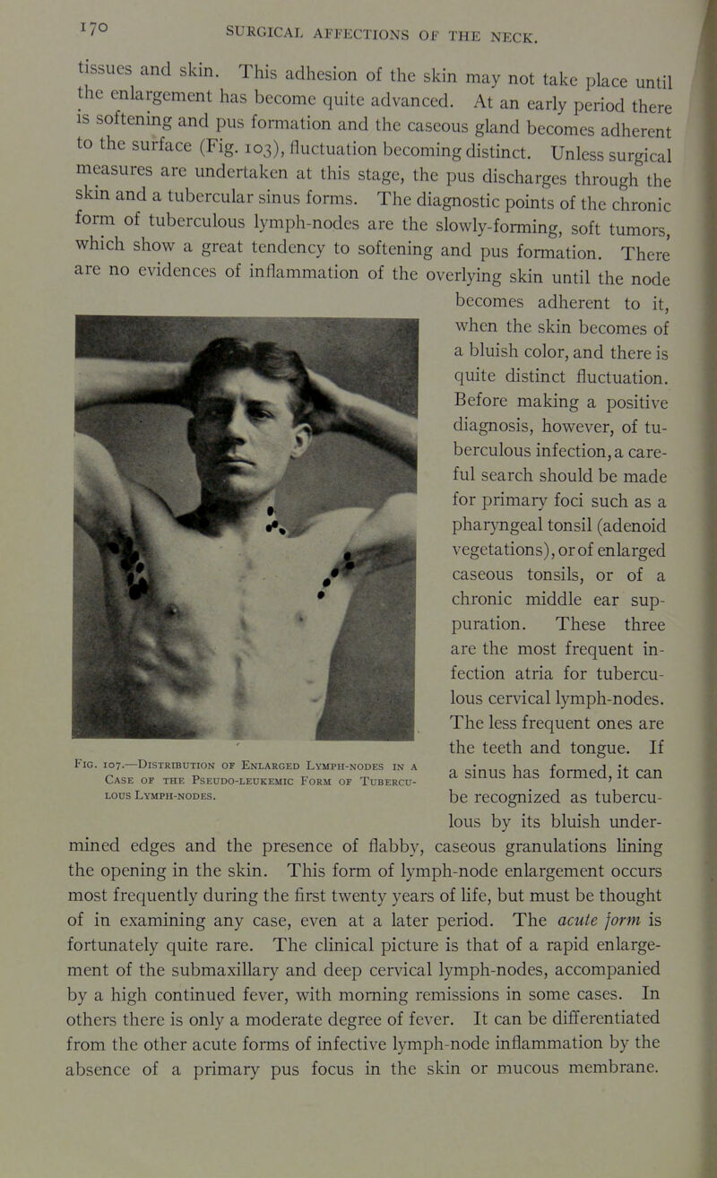 tissues and skin. This adhesion of the skin may not take place until the enlargement has become quite advanced. At an early period there IS softemng and pus formation and the caseous gland becomes adherent to the surface (Fig. 103), fluctuation becoming distinct. Unless surgical measures are undertaken at this stage, the pus discharges through the skin and a tubercular sinus forms. The diagnostic points of the chronic form of tuberculous lymph-nodes are the slowly-forming, soft tumors, which show a great tendency to softening and pus formation. There are no evidences of inflammation of the overlying skin until the node becomes adherent to it, when the skin becomes of a bluish color, and there is quite distinct fluctuation. Before making a positive diagnosis, however, of tu- berculous infection, a care- ful search should be made for primary foci such as a pharyngeal tonsil (adenoid vegetations), or of enlarged caseous tonsils, or of a chronic middle ear sup- puration. These three are the most frequent in- fection atria for tubercu- lous cervical lymph-nodes. The less frequent ones are the teeth and tongue. If a sinus has formed, it can be recognized as tubercu- lous by its bluish under- mined edges and the presence of flabby, caseous granulations lining the opening in the skin. This form of lymph-node enlargement occurs most frequently during the first twenty years of life, but must be thought of in examining any case, even at a later period. The acute form is fortunately quite rare. The clinical picture is that of a rapid enlarge- ment of the submaxillary and deep cervical lymph-nodes, accompanied by a high continued fever, with morning remissions in some cases. In others there is only a moderate degree of fever. It can be dififerentiated from the other acute forms of infective lymph-node inflammation by the absence of a primary pus focus in the skin or mucous membrane. Fig. 107.—Distribution of Enlarged Lymph-nodes in a Case of the Pseudo-leukemic Form of Tubercu- lous Lymph-nodes.