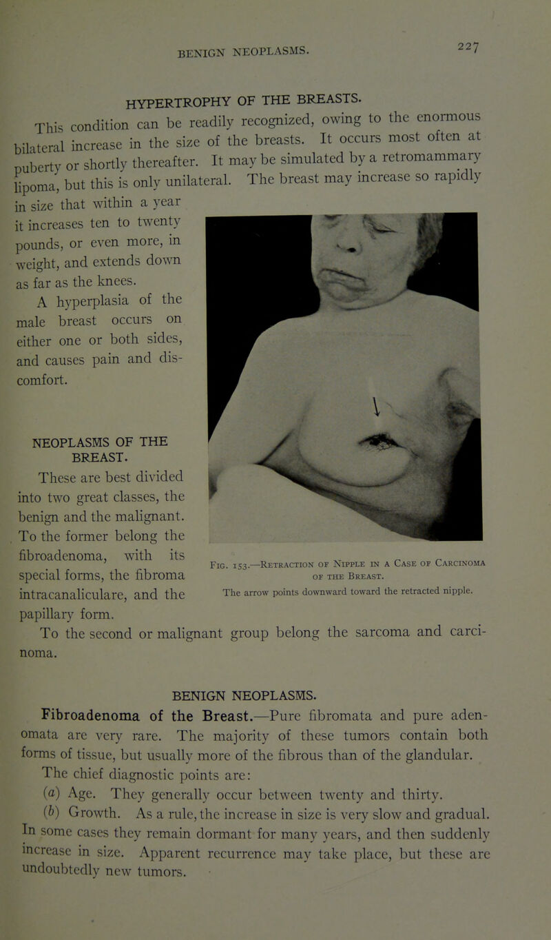 BENIGN NEOPLASMS. HYPERTROPHY OF THE BREASTS. This condition can be readily recognized, owing to the enormous bilateral increase in the size of the breasts. It occurs most often at puberty or shortly thereafter. It may be simulated by a retromammary lipoma, but this is only unilateral. The breast may increase so rapidly in size that within a year it increases ten to twenty pounds, or even more, in weight, and extends down as far as the knees. A hyperplasia of the male breast occurs on either one or both sides, and causes pain and dis- comfort. NEOPLASMS OF THE BREAST. These are best divided into two great classes, the benign and the mahgnant. To the former belong the fibroadenoma, with its special forms, the fibroma intracanahculare, and the papillary form. To the second or malignant group belong the sarcoma and carci- noma. Fig. 153 Retraction or Nipple in a Case of Carcinoma OF THE Breast. The arrow points downward toward the retracted nipple. BENIGN NEOPLASMS. Fibroadenoma of the Breast.—Pure fibromata and pure aden- omata arc very rare. The majority of these tumors contain both forms of tissue, but usually more of the fibrous than of the glandular. The chief diagnostic points are: (a) Age. They generally occur between twenty and thirty. (b) Growth. As a rule, the increase in size is very slow and gradual. In some cases they remain dormant for many years, and then suddenly increase in size. Apparent recurrence may take place, but these are undoubtedly new tumors.