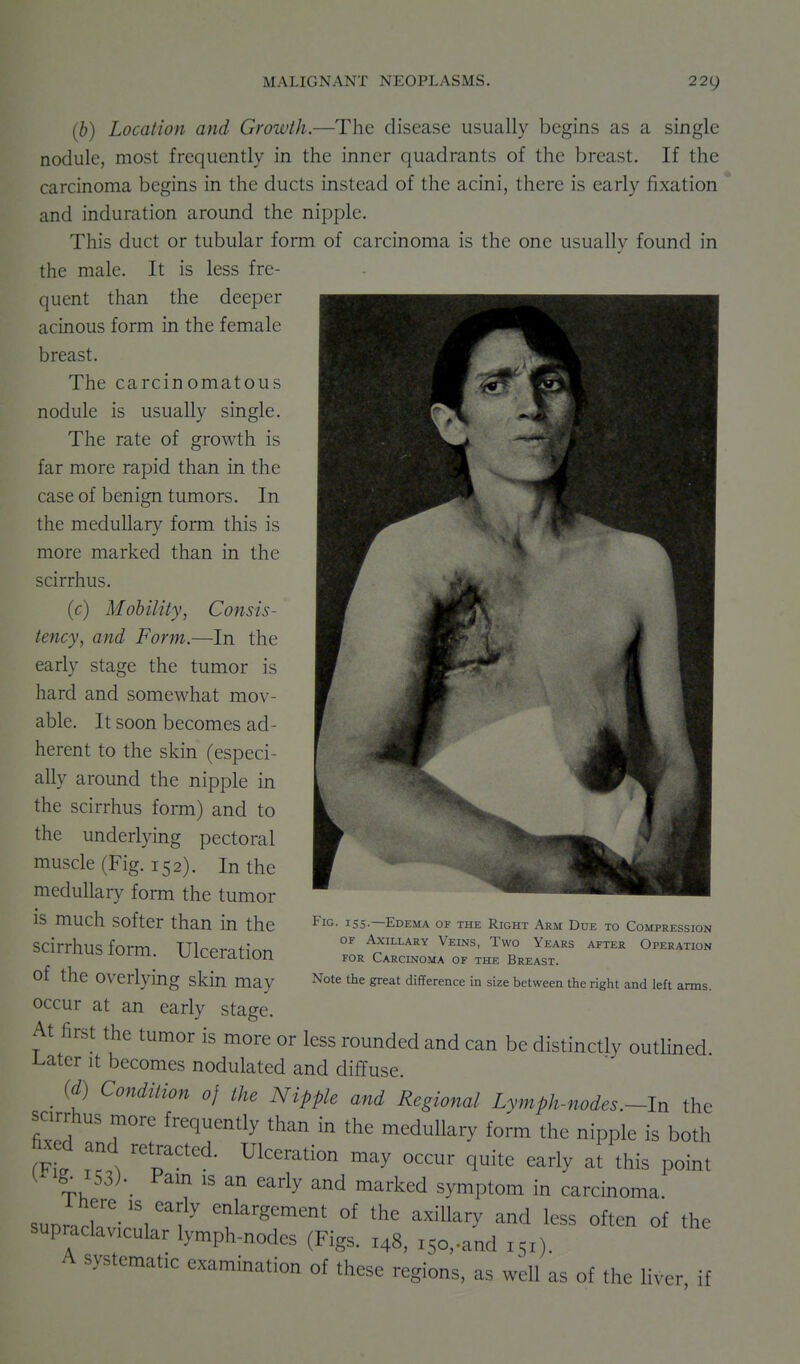 (b) Location and Growth.—The disease usually begins as a single nodule, most frequently in the inner quadrants of the breast. If the carcinoma begins in the ducts instead of the acini, there is early fixation and induration around the nipple. This duct or tubular form of carcinoma is the one usually found in the male. It is less fre- quent than the deeper acinous form in the female breast. The carcinomatous nodule is usually single. The rate of growth is far more rapid than in the case of benign tumors. In the medullary form this is more marked than in the scirrhus. (c) Mobility, Consis- tency, and Form.—In the early stage the tumor is hard and somewhat mov- able. It soon becomes ad- herent to the skin (especi- ally around the nipple in the scirrhus form) and to the underlying pectoral muscle (Fig. 152). In the medullary form the tumor is much softer than in the scirrhus form. Ulceration of the overlying skin may occur at an early stage. At first the tumor is more or less rounded and can be distinctly outlined l^ater it becomes nodulated and diffuse. _ (d) Condition of the Nipple and Regional Lymph-nodes.~ln the scirrhus more frequently than in the medullary form the nipple is both fixed and retracted. Ulceration may occur quite early at this point 153). Pam IS an early and marked symptom in carcinoma. sunrn.r'- ''i '^^ ^^^^^S^^^^^t of the axillary and less often of the supraclavicular lymph-nodes (Figs. 148, isc-and 151). A systematic examination of these regions, as well as of the liver, if Fig. iss—Edema of the Right Arm Due to Compression or Axillary Veins, Two Years after Operation FOR Carcinoma of the Breast. Note the great difference in size between the right and left arms.