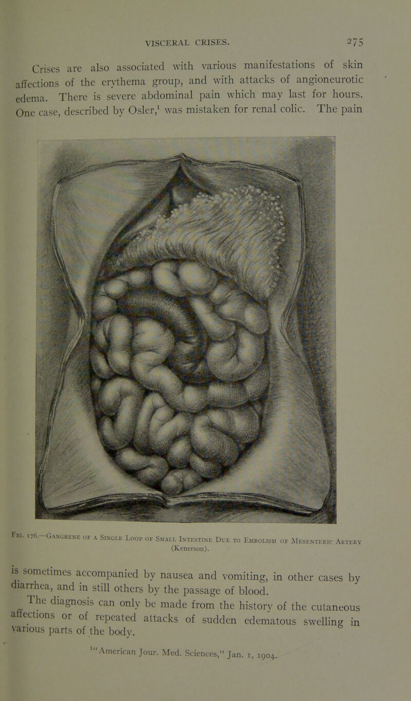 VISCERAL CRISES. Crises arc also associated with various manifestations of skin affections of the erythema group, and with attacks of angioneurotic edema. There is severe abdominal pain which may last for hours. One case, described by Osler,^ was mistaken for renal colic. The pain Fig. 176.-GANGRENE OF A Single Loop of Small Intestine Due to Eaibolism of xMesentkuic Auti-.ry (Kenerson). IS sometimes accompanied by nausea and vomiting, in other cases by diarrhea, and in still others by the passage of blood. The diagnosis can only be made from the historv of the cutaneous attections or of repeated attacks of sudden edematous swelling in various parts of the body. American Jour. Med. Sciences, Jan. i, 1904.