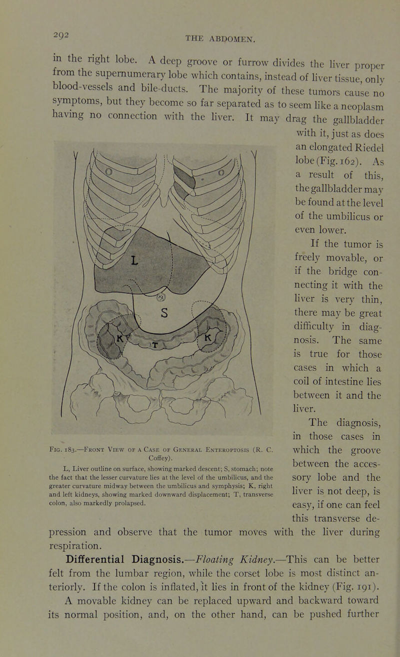 m the right lobe. A deep groove or furrow divides the Hver proper from the supernumerary lobe which contains, instead of hver tissue only blood-vessels and bile-ducts. The majority of these tumors cause no symptoms, but they become so far separated as to seem like a neoplasm havmg no connection with the liver. It may drag the gallbladder with it, just as does an elongated Riedel lobe (Fig. 162). As a result of this, the gallbladder may be found at the level of the umbihcus or even lower. If the tumor is freely movable, or if the bridge con- necting it with the Hver is very thin, there may be great difficulty in diag- nosis. The same is true for those cases in which a coil of intestine lies between it and the liver. The diagnosis, in those cases in which the groove between the acces- sory lobe and the liver is not deep, is easy, if one can feel this transverse de- pression and observe that the tumor moves with the liver during respiration. Differential Diagnosis.—Floating Kidney.—This can be better felt from the lumbar region, while the corset lobe is most distinct an- teriorly. If the colon is inflated, it hes in front of the kidney (Fig. 191). A movable kidney can be replaced upward and backward toward its normal position, and, on the other hand, can be pushed further Fig. 183.—Front View of a Case of General Enteroptosis (R. C. Coffey). L, Liver outline on surface, showing marked descent; S, stomach; note the fact that the lesser curvature lies at the level of the umbilicus, and the greater curvature midway between the umbilicus and symphysis; K, right and left kidneys, showing marked downward displacement; T, transverse colon, also markedly prolapsed.