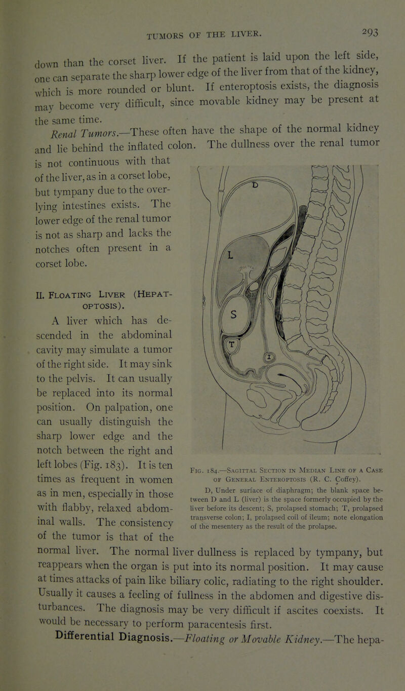 down than the corset liver. If the patient is laid upon the le t side, one can separate the sharp lower edge of the Uver from that of the kidney, which is more rounded or blunt. If enteroptosis exists, the diagnosis may become very difficult, since movable kidney may be present at the same time. Renal Tumors.often have the shape of the normal kidney and lie behind the inflated colon. The dullness over the renal tumor is not continuous with that of the liver, as in a corset lobe, but tympany due to the over- lying intestines exists. The lower edge of the renal tumor is not as sharp and lacks the notches often present in a corset lobe. II. Floating Liver (Hepat- OPTOSIS). A Hver which has de- scended in the abdominal cavity may simulate a tumor of the right side. It may sink to the pelvis. It can usually be replaced into its normal position. On palpation, one can usually distinguish the sharp lower edge and the notch between the right and left lobes (Fig. 183). It is ten times as frequent in women as in men, especially in those with flabby, relaxed abdom- inal walls. The consistency of the tumor is that of the normal hver. The normal Hver dullness is replaced by tympany, but reappears when the organ is put into its normal position. It may cause at times attacks of pain like biliary colic, radiating to the right shoulder. Usually it causes a feeling of fullness in the abdomen and digestive dis- turbances. The diagnosis may be very difficult if ascites coexists. It would be necessary to perform paracentesis first. Differential Diagnosis.—i^^/oa/w^ or Movable Kidney.—The hepa- Fig. 184.—Sagittal Section in IMedian Line of a Case OF General Enteroptosis (R. C. Coffey). D, Under surface of diaploragm; the blank space be- tween D and L (liver) is the space formerly occupied by the liver before its descent; S, prolapsed stomach; T, prolapsed transverse colon; I, prolapsed coil of ileum; note elongation of the mesentery as the result of the prolapse.