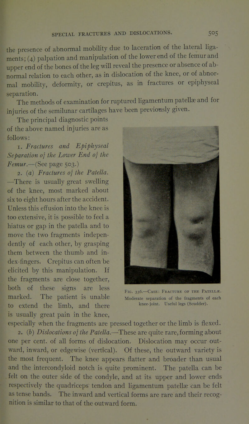 the presence of abnormal mobility due to laceration of the lateral liga- ments; (4) palpation and manipulation of the lower end of the femur and upper end of the bones of the leg will reveal the presence or absence of ab- normal relation to each other, as in dislocation of the knee, or of abnor- mal mobihty, deformity, or crepitus, as in fractures or epiphyseal separation. The methods of examination for ruptured ligamentum patellae and for injuries of the semilunar cartilages have been previously given. The principal diagnostic points of the above named injuries are as follows: 1. Fractures and Epiphyseal Separation 0} the Lower End 0} the Femur.—(See page 503.) 2. (a) Fractures of the Patella. —There is usually great swelling of the knee, most marked about six to eight hours after the accident. Unless this effusion into the knee is too extensive, it is possible to feel a hiatus or gap in the patella and to move the two fragments indepen- dently of each other, by grasping them between the thumb and in- dex-fingers. Crepitus can often be elicited by this manipulation. If the fragments are close together, both of these signs are less marked. The patient is unable to extend the limb, and there is usually great pain in the knee, especially when the fragments are pressed together or the limb is flexed. 2. (6) Dislocations of the Patella.—These are quite rare, forming about one per cent, of all forms of dislocation. Dislocation may occur out- ward, inward, or edgewise (vertical). Of these, the outward variety is the most frequent. The knee appears flatter and broader than usual and the intercondyloid notch is quite prominent. The patella can be felt on the outer side of the condyle, and at its upper and lower ends respectively the quadriceps tendon and ligamentum patelLne can be felt as tense bands. The inward and vertical forms are rare and their recog- nition is similar to that of the outward form. Fig. 336.—Case: Fracture of the Patella. Moderate separation of the fragments of each knee-joint. Useful legs (Scudder).