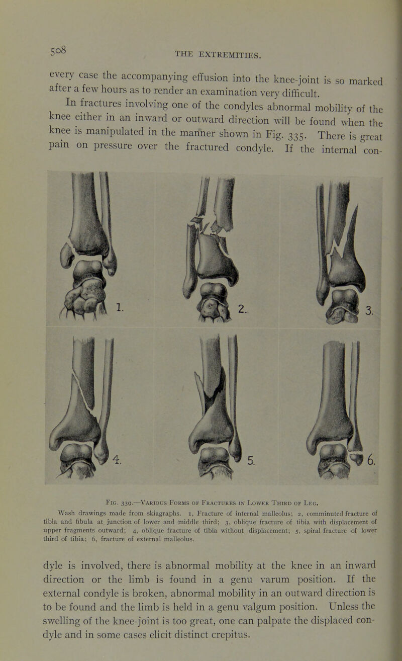 every case the accompanying effusion into the knee-joint is so marked after a few hours as to render an examination very difficuU. In fractures involving one of the condyles abnormal mobihty of the knee either in an inward or outward direction will be found when the knee is manipulated in the manner shown in Fig. 335. There is great pain on pressure over the fractured condyle. If the internal con- Fig. 339.—Various Forms of Fractures in Lower Third of Leg. Wash drawings made from skiagraphs, i, Fracture of internal malleohis; 2, comminuted fracture of tibia and fibula at junction of lower and middle third; 3, oblique fracture of tibia with displacement of upper fragments outward; 4, oblique fracture of tibia without displacement; 5, spiral fracture of lower third of tibia; 6, fracture of external malleolus. dyle is involved, there is abnormal mobihty at the knee in an inward direction or the limb is found in a genu varum position. If the external condyle is broken, abnormal mobility in an outward direction is to be found and the limb is held in a genu valgum position. Unless the sweUing of the knee-joint is too great, one can palpate the displaced con- dyle and in some cases ehcit distinct crepitus.