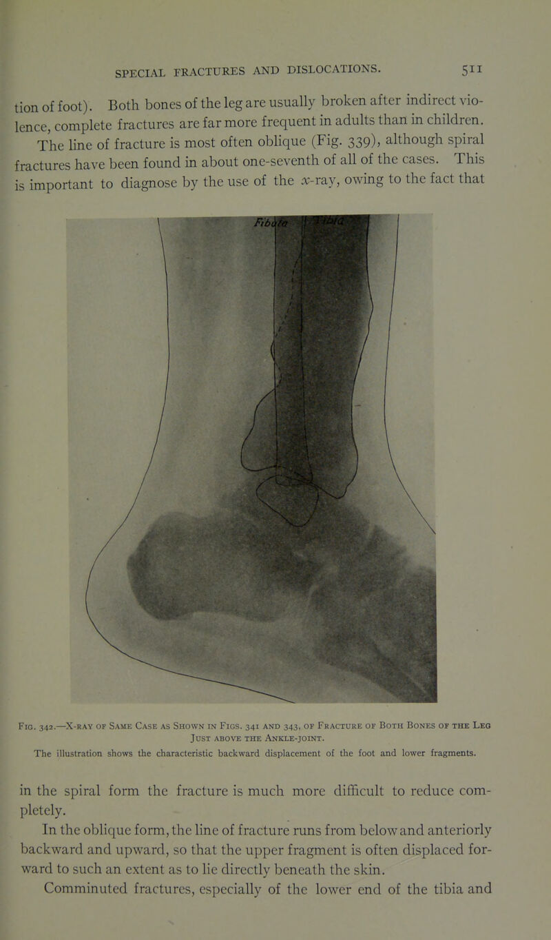 tion of foot). Both bones of the leg are usually broken after indirect vio- lence, complete fractures are far more frequent in adults than in children. The line of fracture is most often oblique (Fig. 339), although spiral fractures have been found in about one-seventh of all of the cases. This is important to diagnose by the use of the x-T2.y, owing to the fact that Fig. 342.—X-RAY OF Same Case as Shown in Figs. 341 and 343, of Fracture of Both Bones of the Leo Just above the Ankle-joint. The illustration shows the characteristic backward displacement of the foot and lower fragments. in the spiral form the fracture is much more difficult to reduce com- pletely. In the oblique form, the line of fracture runs from below and anteriorly backward and upward, so that the upper fragment is often displaced for- ward to such an extent as to lie directly beneath the skin. Comminuted fractures, especially of the lower end of the tibia and