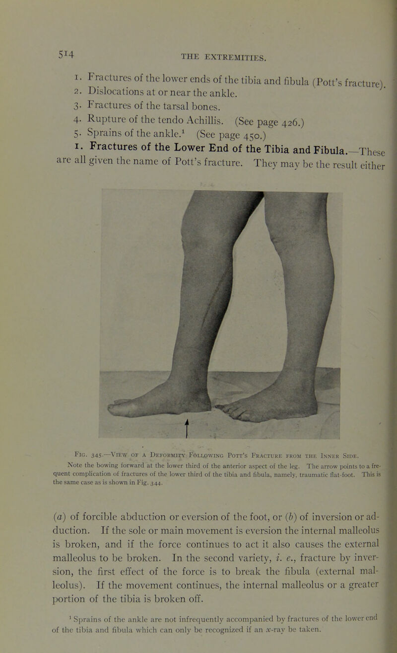 1. Fractures of the lower ends of the tibia and fibula (Pott's fracture) 2. Dislocations at or near the ankle. 3. Fractures of the tarsal bones. 4. Rupture of the tendo Achillis. (See page 426.) 5. Sprains of the ankle.^ (See page 450.) I. Fractures of the Lower End of the Tibia and Fibula.—These all given the name of Pott's fracture. They may be the result either Fig. 345.—VrEW OF a Deformity rdLtowiNG Pott's Fracture from the Inner Side. Note the bowing forward at the lower third of the anterior aspect of the leg. The arrow points to a fre- quent complication of fractures of the lower third of the tibia and fibula, namely, traumatic flat-foot. This if the same case as is shown in Fig. 344. {a) of forcible abduction or eversion of the foot, or (b) of inversion or ad- duction. If the sole or main movement is eversion the internal malleolus is broken, and if the force continues to act it also causes the external malleolus to be broken. In the second variety, i. e., fracture by inver- sion, the first effect of the force is to break the fibula (external mal- leolus). If the movement continues, the internal malleolus or a greater portion of the tibia is broken off. ' Sprains of the ankle are not infrequently accompanied by fractures of the lower end of the tibia and fibula which can only be recognized if an .Y-ray be taken.