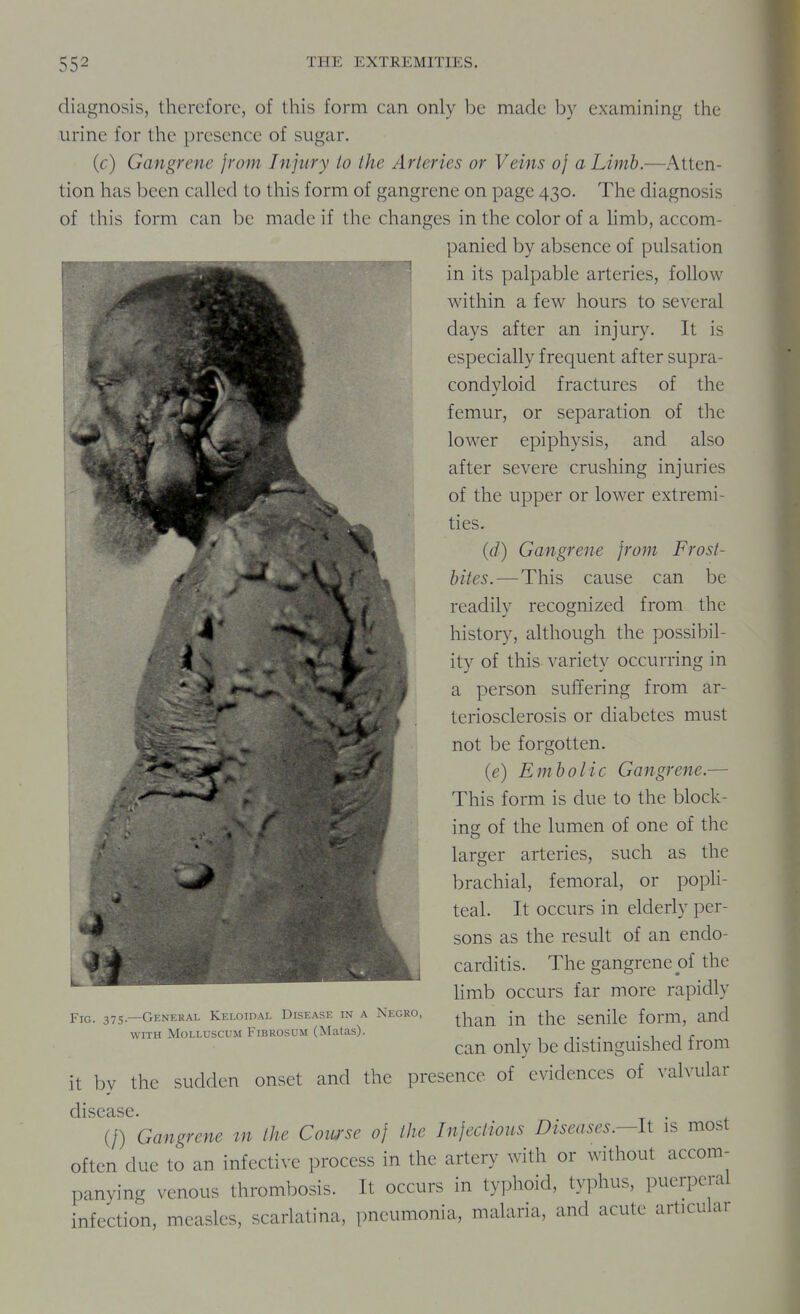 diagnosis, therefore, of this form can only be made by examining the urine for the presence of sugar. (c) Gangrene from Injury to the Arteries or Veins oj a Limb.—Atten- tion has been called to this form of gangrene on page 430. The diagnosis of this form can be made if the changes in the color of a limb, accom- panied by absence of pulsation in its palpable arteries, follow within a few hours to several days after an injury. It is especially frequent after supra- condyloid fractures of the femur, or separation of the lower epiphysis, and also after severe crushing injuries of the upper or lower extremi- ties. (d) Gangrene from Frost- bites.—This cause can be readily recognized from the history, although the possibil- ity of this variety occurring in a person suffering from ar- teriosclerosis or diabetes must not be forgotten. (e) Embolic Gangrene.— This form is due to the block- ing of the lumen of one of the larger arteries, such as the brachial, femoral, or popli- teal. It occurs in elderly per- sons as the result of an endo- carditis. The gangrene j3f the limb occurs far more rapidly than in the senile form, and can only be distinguished from it by the sudden onset and the presence of evidences of valvular (/) Gangre7ie in the Cowse of the Infectious Diseases.—li is most often due to an infective process in the artery with or without accom- panying venous thrombosis. It occurs in typhoid, typhus, puerperal infection, measles, scarlatina, pneumonia, malaria, and acute articular Pjc. 375—General Keloidal Disease in a Negro, WITH MoLLUscuM FiBROSuM (Matas).