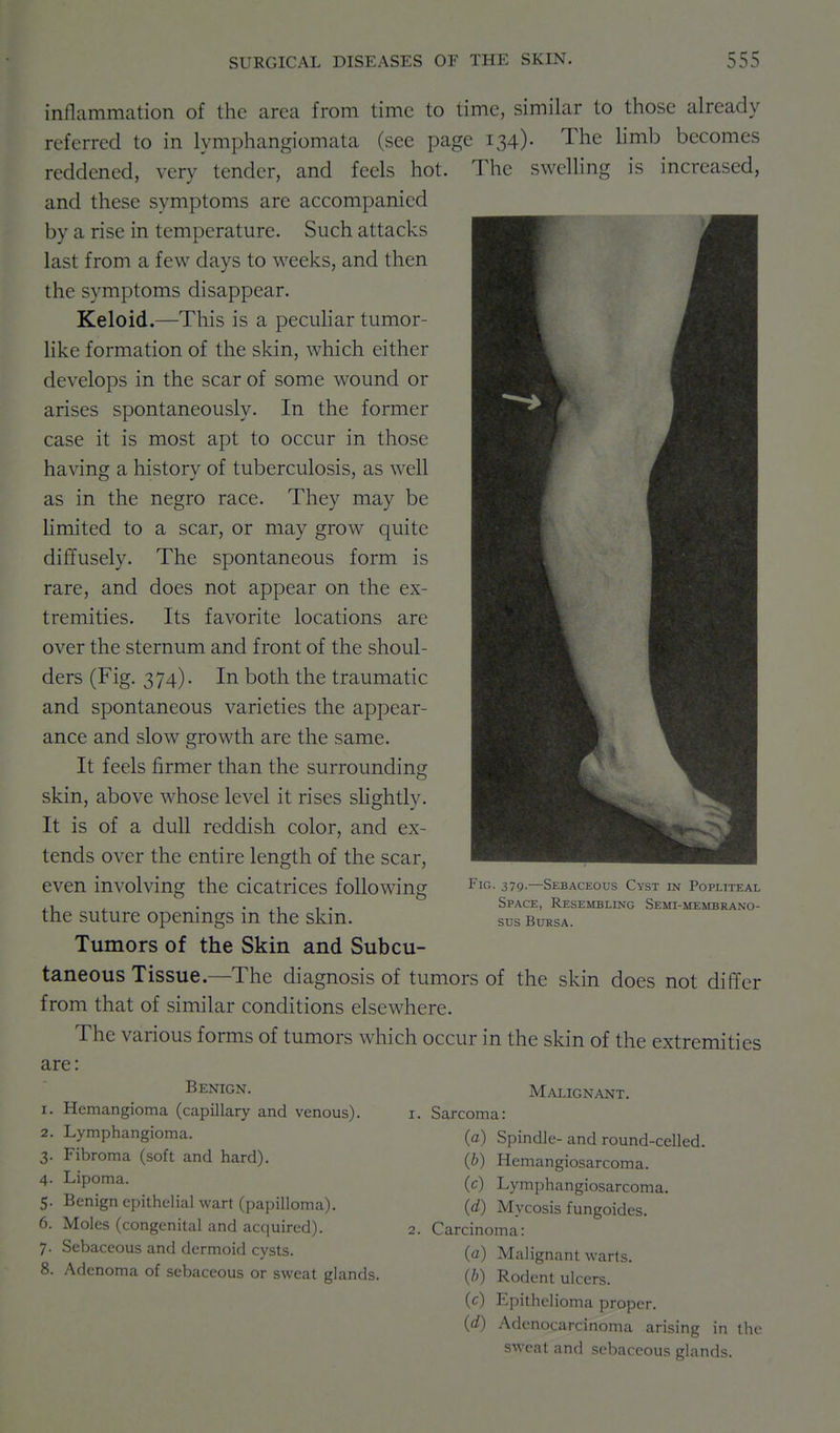 inflammation of the area from time to time, similar to those already referred to in lymphangiomata (see page 134)- The limb becomes reddened, very tender, and feels hot. The swelling is increased, and these symptoms are accompanied by a rise in temperature. Such attacks last from a few days to weeks, and then the symptoms disappear. Keloid.—This is a pecuHar tumor- like formation of the skin, which either develops in the scar of some wound or arises spontaneously. In the former case it is most apt to occur in those having a history of tuberculosis, as well as in the negro race. They may be limited to a scar, or may grow quite diffusely. The spontaneous form is rare, and does not appear on the ex- tremities. Its favorite locations are over the sternum and front of the shoul- ders (Fig. 374). In both the traumatic and spontaneous varieties the appear- ance and slow growth are the same. It feels firmer than the surrounding skin, above whose level it rises shghtly. It is of a dull reddish color, and ex- tends over the entire length of the scar, even involving the cicatrices following the suture openings in the skin. Tumors of the Skin and Subcu- taneous Tissue.—The diagnosis of tumors of the skin does not differ from that of similar conditions elsewhere. The various forms of tumors which occur in the skin of the extremities are: Malignant. 1. Sarcoma: {a) Spindle- and round-celled. (b) Hemangiosarcoma. (c) Lymphangiosarcoma. (d) Mycosis fungoides. 2. Carcinoma: (a) Malignant warts. (b) Rodent ulcers. (c) Epithelioma proper. (d) Adenocarcinoma arising in the sweat and sebaceous glands. Fig. 379.—Sebaceous Cyst in Popliteal Space, Resembling Semi-membrano- sus Bursa. Benign. 1. Hemangioma (capillary and venous). 2. Lymphangioma. 3. Fibroma (soft and hard). 4. Lipoma. 5. Benign epithelial wart (papilloma). 6. Moles (congenital and acquired). 7. Sebaceous and dermoid cysts. 8. Adenoma of sebaceous or sweat glands.