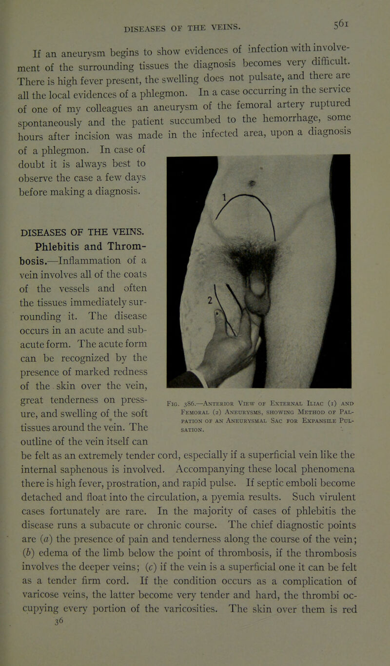 If an aneurysm begins to show evidences of infection with involve- ment of the surrounding tissues the diagnosis becomes very difficult. There is high fever present, the swelling does not pulsate, and there are all the local evidences of a phlegmon. In a case occurring in the service of one of my colleagues an aneurysm of the femoral artery ruptured spontaneously and the patient succumbed to the hemorrhage, some hours after incision was made in the infected area, upon a diagnosis of a phlegmon. In case of doubt it is always best to observe the case a few days before making a diagnosis. DISEASES OF THE VEINS. Phlebitis and Throm- bosis.—Inflammation of a vein involves all of the coats of the vessels and often the tissues immediately sur- rounding it. The disease occurs in an acute and sub- acute form. The acute form can be recognized by the presence of marked redness of the skin over the vein, great tenderness on press- ure, and swelling of^ the soft tissues around the vein. The Fig. 386.—Anterior View of External Iliac (i) and Femoral (2) Aneurysms, showing Method of Pal- pation OF an Aneurysmal Sac for Expansile Pul- sation. outhne of the vein itself can be felt as an extremely tender cord, especially if a superficial vein like the internal saphenous is involved. Accompanying these local phenomena there is high fever, prostration, and rapid pulse. If septic emboli become detached and float into the circulation, a pyemia results. Such virulent cases fortunately are rare. In the majority of cases of phlebitis the disease runs a subacute or chronic course. The chief diagnostic points are (a) the presence of pain and tenderness along the course of the vein; (b) edema of the Hmb below the point of thrombosis, if the thrombosis involves the deeper veins; (c) if the vein is a superficial one it can be felt as a tender firm cord. If the condition occurs as a compKcation of varicose veins, the latter become very tender and hard, the thrombi oc- cupying every portion of the varicosities. The skin over them is red 36