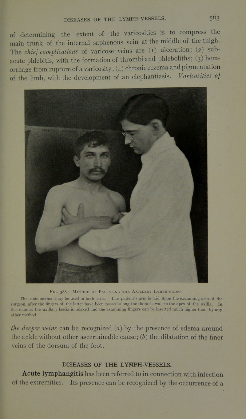 of determining the extent of the varicosities is to compress the main trunk of the internal saphenous vein at the middle of the thigh. The chief complications of varicose veins are (i) ulceration; (2) sub- acute phlebitis, with the formation of thrombi and phlebohths; (3) hem- orrhage from rupture of a varicosity; (4) chronic eczema and pigmentation of the limb, with the development of an elephantiasis. Varicosities 0} Fig. 388.—Method of Palpating the Axillary Lymph-nodes. The same method may be used in both sexes. The patient's arm is laid upon the examining arm of the surgeon, after the fingers of the latter have been passed along the thoracic wall to the apex of the axilla. In this manner the axillary fascia is relaxed and the examining fingers can be inserted much liigher than by any other method. the deeper veins can be recognized (a) by the presence of edema around the ankle without other ascertainable cause; (b) the dilatation of the finer veins of the dorsum of the foot. DISEASES OF THE LYMPH-VESSELS. Acute lymphangitis has been referred to in connection with infection of the extremities. Its presence can be recognized by the occurrence of a