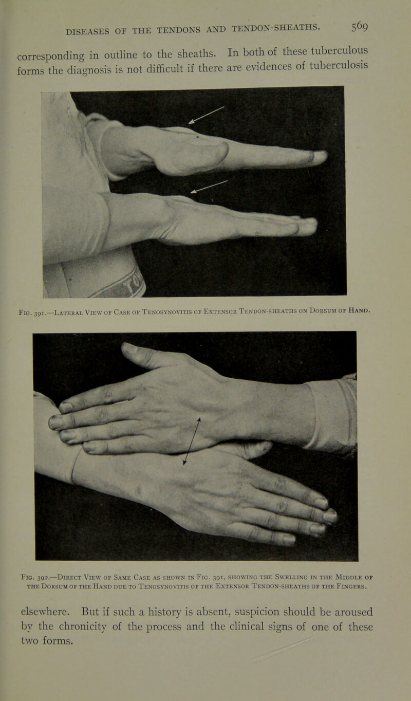 corresponding in outline to the sheaths. In both of these tuberculous forms the diagnosis is not difficult if there are evidences of tuberculosis Fig. 301—Lateral View of Case of Tenosynovitis of Extensor Tendon-sheaths on Dorsum of Hand. Fig. 392.—Direct View of Same Case as shown in Fig. 391, showing the Swelling in the Middle op the Dorsum of the Hand due to Tenosynovitis of the Extensor Tendon-sheaths of the Fingers. elsewhere. But if such a history is absent, suspicion should be aroused by the chronicity of the process and the clinical signs of one of these two forms.